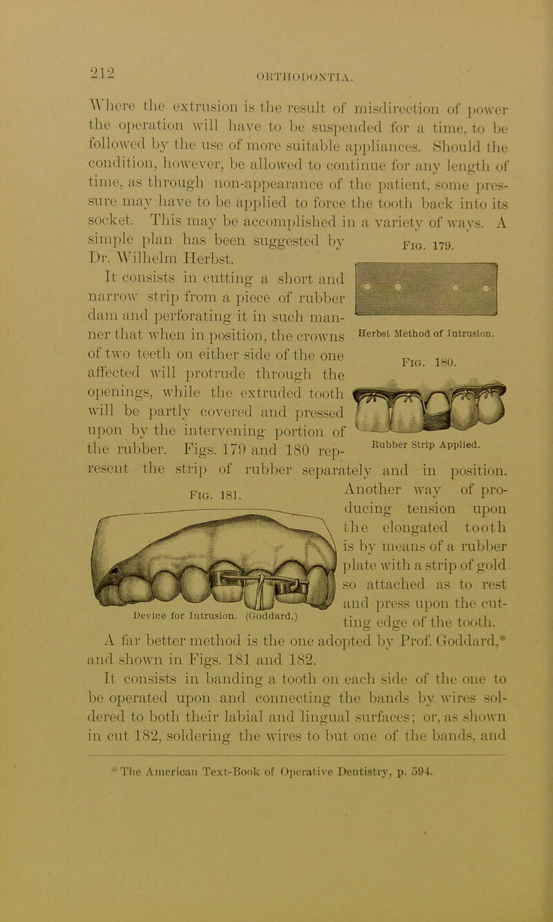 ORTHODONTIA. FIG. 179. Where the extrusion is the result of misdirection of power the operation will have to lie suspended for a time, to be followed by the use of more suitable appliances. Should the condition, however, be allowed to continue for any length of time, as through non-appearance of the patient, some pres- sure may have to be applied to force the tooth back into its socket. This may be accomplished in a variety of ways. A simple plan has been suggested by I)r. Wilhelm Herbst. It consists in cutting a short and narrow strip from a piece of rubber dam and perforating it in such man- ner that when in position, the crowns of two teeth on either side of the one affected will protrude through the openings, while the extruded tooth will be partly covered and pressed upon by the intervening portion of the rubber. Figs. 179 and 180 rep- resent the strip of rubber separately and in position. Another way of pro- ducing tension upon the el ongated toot h is by means of a rubber plate with a strip of gold so attached as to rest and press upon the cut- tine- edge of the tooth. o o Herbst Method of Intrusion. Fig. 180. Rubber Strip Applied. Fig. 181. Device for lutrusion. (Goddard.) A far better method is the one adopted by Prof. Goddard,* and shown in Figs. 181 and 182. It consists in banding a tooth on each side of the one to be operated upon and connecting the bands by wires sol- dered to both their labial and lingual surfaces; or, as shown in cut 182, soldering the wires to but one of the bands, and