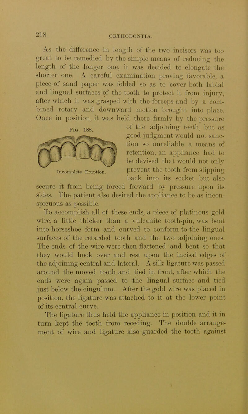 As the difference in length of the two incisors was too great to be remedied by the simple means of reducing the length of the longer one, it was decided to elongate the shorter one. A careful examination proving favorable, a piece of sand paper was folded so as to cover both labial and lingual surfaces of the tooth to protect it from injury, after which it was grasped with the forceps and by a com- bined rotary and downward motion brought into place. Once in position, it was held there firmly by the pressure of the adjoining teeth, but as good judgment would not sanc- tion so unreliable a means of retention, an appliance had to be devised that would not only prevent the tooth from slipping back into its socket but also secure it from being forced forward by pressure upon its sides. The patient also desired the appliance to be as incon- spicuous as possible. To accomplish all of these ends, a piece of platinous gold wire, a little thicker than a vulcanite tooth-pin, was bent into horseshoe form and curved to conform to the lingual surfaces of the retarded tooth and the two adjoining ones. The ends of the wire were then flattened and bent so that they would hook over and rest upon the incisal edges of the adjoining central and lateral. A silk ligature was passed around the moved tooth and tied in front, after which the ends were again passed to the lingual surface and tied just below the cingulum. After the gold wire was placed in position, the ligature was attached to it at the lower point of its central curve. The ligature thus held the ajDpliance in position and it in turn kept the tooth from receding. The double arrange- ment of wire and ligature also guarded the tooth against Fig. 188. Incomplete Eruption.