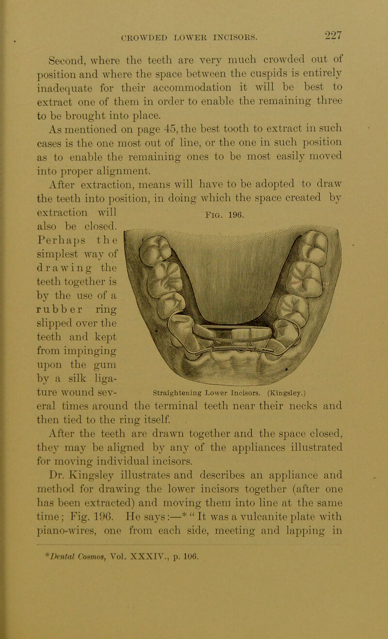 CROWDED LOWER INCISORS. Second, where the teeth are very much crowded out of position and where the space between the cuspids is entirely inadequate for their accommodation it will be best to extract one of them in order to enable the remaining three to be brought into place. As mentioned on page 45, the best tooth to extract in such cases is the one most out of line, or the one in such position as to enable the remaining ones to be most easily moved into proper alignment. After extraction, means will have to be adopted to draw the teeth into position, in doing which the space created by extraction will also be closed. Perhaps the simplest way of d r a w i n g the teeth together is by the use of a rubber ring slipped over the teeth and kept from impinging upon the gum bv a silk liga- O Fig. 196. tlire WOlind sev- Straightening Lower Incisors. (Kingsley.) eral times around the terminal teeth near their necks and then tied to the ring itself. After the teeth are drawn together and the space closed, they may be aligned by any of the appliances illustrated for moving individual incisors. Dr. Kingsley illustrates and describes an appliance and method for drawing the lower incisors together (after one has been extracted) and moving them into line at the same time; Fig. 196. He says:—* “ It was a vulcanite plate with piano-wires, one from each side, meeting and lapping in