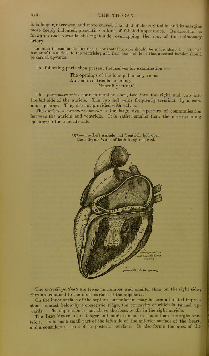 it is longer, narrower, and more curved than that of the right side, and its margins more deeply indented, presenting a kind of foliated appearance. Its direction is forwards and towards the right side, overlapping the root of the pulmonary artery. In order to examine its interior, a horizontal incision shonld be made along the attached border of the auricle to the ventricle •, and from the middle of this, a second incision should be earned upwards. The following parts then present themselves for examination :— The openings of the four pulmonary veins. Auriculo-ventricular opening. Musculi pectinati. The pulmonary veins, four in number, open, two into the right, and two into the left side of the auricle. The two left veins frequently tei’minate by a com- mon opening. They are not provided with valves. The auriculo-ventricular opening is the large oval aperture of communication between the auricle and ventricle. It is rather smaller than the corresponding opening on the opposite side. 357-—The Left Auricle and Ventricle laid open, the anterior Walls of both being removed. The musculi pectinati are fewer in number and smaller than on the right side ; they are confined to the inner surface of the appendix. On the inner surface of the septum auricularum may bo seen a lunated impres- sion, bounded below by a crescentic ridge, the concavity of which is turned up- wards. The depression is just above the fossa ovalis in the right auricle. The Left Ventricle is longer and more conical in shape than the right ven- tricle. It forms a small part of the left side of tho anterior surface of the heart, and a considerable part of its posterior surface. It also forms the apex of the