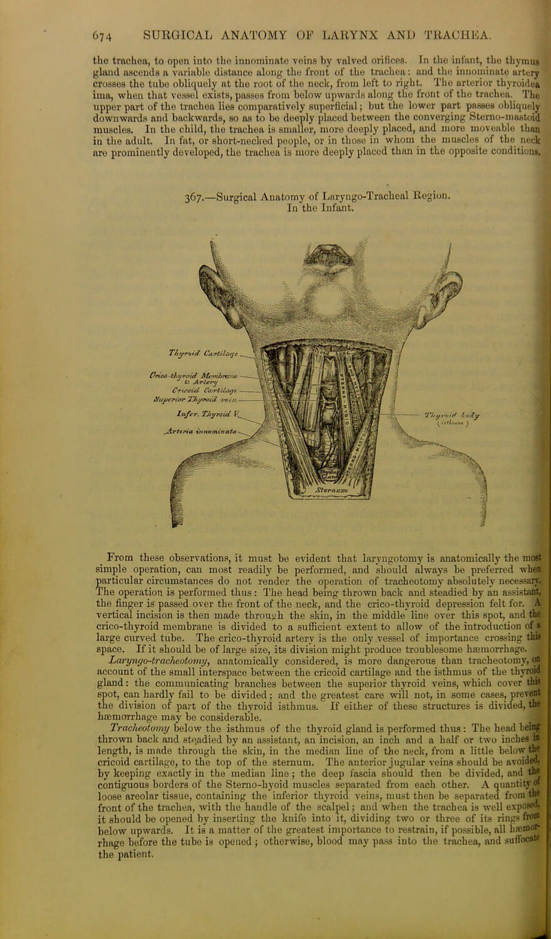 the trachea, to open into the innominate veins by valved orifices. In the infant, the thymus gland ascends a variable distance along the front of the trachea: and the innominate artery crosses the tube obliquely at the root of the neck, from left to right. The arterior thyroidea ima, when that vessel exists, passes from below upwards along the front of the trachea. The upper part of the trachea lies comparatively superficial; but the lower part passes obliquely downwards and backwards, so as to bo deeply placed between the converging Sterno-mastoid muscles. In the child, the trachea is smaller, more deeply placed, and more moveable than in the adult. In fat, or short-necked people, or in those in whom the muscles of the neck are prominently developed, the trachea is more deeply placed than in the opposite conditions. 367.—Surgical Anatomy of Lnryngo-Tracheal Region. In the Infant. From these observations, it must be evident that laryngotomy is anatomically the most simple operation, can most readily be performed, and should always be preferred when particular circumstances do not render the operation of tracheotomy absolutely necessary. The operation is performed thus: The head being thrown back and steadied by an assistant, the finger is passed over the front of the neck, and the crico-thyroid depression felt for. A vertical incision is then made through the skin, in the middle line over this spot, and the crico-thyroid membrane is divided to a sufficient extent to allow of the introduction of« large curved tube. The crico-thyroid artery is the only vessel of importance crossing this space. If it should be of large size, its division might produce troublesome haemorrhage. Laryngo-tracheotomy, anatomically considered, is more dangerous than tracheotomy, on account of the small interspace between the cricoid cartilage and the isthmus of the thyroid gland: the communicating branches between the superior thyroid veins, which cover this spot, can hardly fail to be divided; and the greatest care will not, in some cases, prevent the division of part of the thyroid isthmus. If either of these structures is divided, th&j haemorrhage may be considerable. Tracheotomy below the isthmus of the thyroid gland is performed thus: The head being thrown back and steadied by an assistant, an incision, an inch aod a half or two inches 5n length, is made through the skin, in the median line of the neck, from a little below the cricoid cartilage, to the top of the sternum. The anterior jugular veins should be avoided, by keeping exactly in the median line ; the deep fascia should then be divided, and thB contiguous borders of the Sterno-hyoid muscles separated from each other. A quantity of loose areolar tissue, containing the inferior thyroid veins, must then be separated from the front of the trachea, with the handle of the scalpel; and when the trachea is well exposed, it should be opened by inserting the knife into it, dividing two or three of its rings fro® below upwards. It is a matter of the greatest importance to restrain, if possible, all ba3mor* rhage before the tube is opened ; otherwise, blood may pass into the trachea, and suffocate the patient. Thyroid- Cartilage Orioo -thy void Membrane tz Artery Cricoid Cartilage. &ugitrior Thyroid vt/in Infer. TJiyroul ^Artcria- %n nominal a fi 7/y roief it oily ^ ixtlifiirm ^