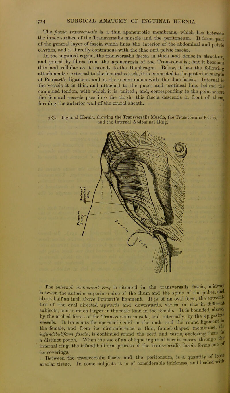 The fascia transversalis is a thin aponeurotic membrane, which lies between the inner surface of tho Transversalis muscle and the peritoneum. It forms part of the general layer of fascia which linos the interior of the abdominal and pelvic cavities, and is directly continuous with the iliac and pelvic fasciae. In the inguinal region, the transversalis fascia is thick and dense in structure, and joined by fibres from the aponeurosis of the Transversalis; but it becomes thin and cellular as it ascends to the Diaphragm. Below, it has the following attachments : external to the femoral vessels, it is connected to the posterior margin of Poupart’s ligament, and is there continuous with the iliac fascia. Internal to the vessels it is thin, and attached to the pubes and pectineal line, behind the conjoined tendon, with which it is united ; and, corresponding to the point where the femoi'al vessels pass into the thigh, this fascia descends in front of them, forming tho anterior wall of the crural sheath. 387. -Inguinal Hernia, showing the Transversalis Muscle, the Transversalis Fascia, and the Internal Abdominal Ring. The internal abdominal ring is situated in the transversalis fascia, midway between the anterior superior spine of the ilium and the spine of the pubes, an about half an inch above Poupart’s ligament. It is of an oval form, the extreme ties of the oval directed upwards and downwards, varies in size in different subjects, and is much larger in the male than in the female. It is bounded, above, by the arched fibres of the Transversalis muscle, and internally, by the epigastric vessels. It transmits the spermatic cord in the male, and the round ligament in the female, and from its circumference a thin, funnel-shaped membrane, tlf infundibuhform fascia, is continued round the cord and testis, enclosing them m a distinct pouch. When the sac of an oblique inguinal hernia passes through the internal ring, the infundibuliform process of tho transversalis fascia foi’ins ono 0 its coverings. Between the transversalis fascia and the peritoneum, is a quantity of loose areolar tissue. In some subjects it is nf considerable thickness, and loaded wit
