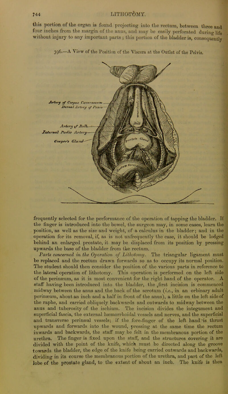 LITHOTOMY. this portion of the organ is found projecting into the rectum, between three and four inches from the margin of the anus, and may he easily perforated during life without injury to any important parts ; this portion of the bladder is, consequently 396.—A View of the Position of the Viscera at the Outlet of the Pelvis, Artery of Corpus Cavernosum. Dorsal Artery of D&ui's Cou’prr's frequently selected for the performance of the operation of tapping the bladder. If the finger is introduced into the bowel, the surgeon may, in some cases, learn the position, as well as the size and weight, of a calculus in the bladder; and in the operation for its removal, if, as is not unfrequently the case, it should be lodged behind an enlarged prostate, it may be displaced from its position by pressing upwards the base of the bladder from the rectum. Parts concerned in the Operation of Lithotomy. The triangular ligament must be replaced and the rectum drawn forwards so as to occupy its normal position. The student should then consider the position of the various parts in reference to the lateral operation of lithotomy. This operation is performed on the left side of the perinaeum, as it is most convenient for the right hand of the operator. A staff having been introduced into the bladder, the ofirst incision is commenced midway between the anus and the back of the scrotum ([i.e., in an orbinary adult perinaeum, about an inch and a half in front of the anus), a little on the left side of the raphe, and carried obliquely backwards and outwards to midway between the anus and tuberosity of the ischium. The incision divides the integument and superficial fascia, the external haemorrhoidal vessels and nerves, and the superficial and transverse perinaeal vessels; if the fore-finger of the left hand is thrust upwards and forwards into the wound, pressing at the same time the rectum inwards and backwards, the staff may be felt in the membranous portion of the urethra. The finger is fixed upon the staff, and the structures covering it are divided with the point of the knife, which must be directed along tho groove towards the bladder, the edge of the knife being carried outwards and backwards, dividing in its course the membranous portion of the urethra, and part of the left lobe of the prostate gland, to the extant of about an inch. Tho knife is then