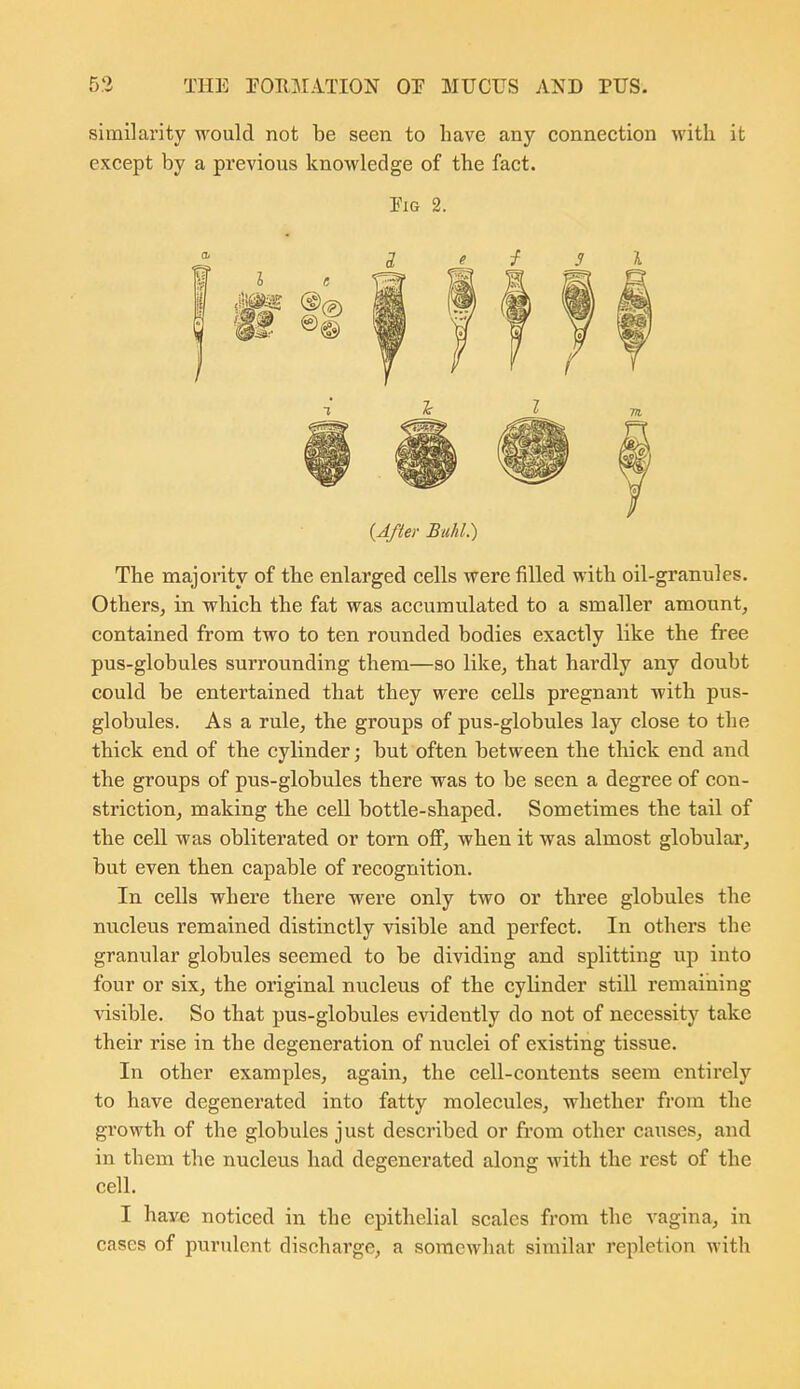 similarity would not be seen to have any connection with it except by a previous knowledge of the fact. EiG 2. {After Buhl.) The majority of the enlarged cells were filled with oil-granules. Others, in which the fat was accumulated to a smaller amount, contained from two to ten rounded bodies exactly like the free pus-globules surrounding them—so like, that hardly any doubt could be entertained that they were cells pregnant with pus- globules. As a rule, the groups of pus-globules lay close to the thick end of the cylinder; but often between the thick end and the groups of pus-globules there was to be seen a degree of con- striction, making the cell bottle-shaped. Sometimes the tail of the cell was obliterated or torn oflF, when it was almost globulai, but even then capable of recognition. In cells where there were only two or three globules the nucleus remained distinctly visible and perfect. In others the granular globules seemed to be dividing and splitting up into four or six, the original nucleus of the cylinder still remaiiiing visible. So that pus-globules evidently do not of necessity take their rise in the degeneration of nuclei of existing tissue. In other examples, again, the cell-contents seem entirely to have degenerated into fatty molecules, whether from the growth of the globules just described or from other causes, and in them the nucleus had degenerated along with the rest of the cell. I have noticed in the epithelial scales from the vagina, in cases of purulent discharge, a somewhat similar repletion with