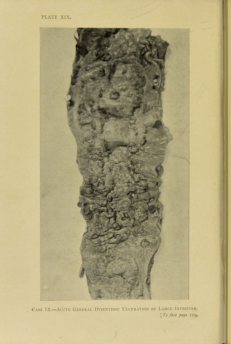 PLATE XIX. Case IX.—Acute Genkkai. Dysenteric Ulceration ok Large Intestine. [ To face page 119.
