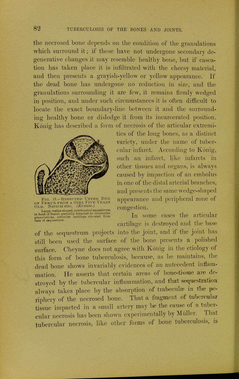 the necrosed bone depends on the condition of the granulations which surround it; if these have not undergone secondary de- generative changes it may resemble healthy bone, but if casea- tion has taken place it is infiltrated with the cheesy material, and then presents a grayish-yellow or yellow appearance. If the dead bone has undergone no reduction in size, and the granulations surrounding it are few, it remains firmly wedged in position, and under such circumstances it is often diificult to locate the exact boundary-line between it and the surround- ing healthy bone or dislodge it from its incarcerated position. Konig has described a form of necrosis of the articular extremi- ties of the long bones, as a distinct variety, under the name of tuber- cular infarct. According to Konig, such an infarct, like infarcts in other tissues and organs, is always caused by impaction of an embolus in one of the distal arterial branches, and presents the same wedge-shaped appearance and peripheral zone of Fig. 19.—Resected Upper End OF Femur from a Girl Five Years Old. Katuial size. {Krause.) Large, wedge-shaped, subchondral sequestrum in head of femur, partially detached by tubercular granulations, articular cartilage elevated from base of sequestrum. congestion. In some cases the articular cartilage is destroyed and the base of the sequestrum projects into the joint, and if the joint has still been used the surface of the bone presents a polished surface. Cheyne does not agree with Konig in the etiology of this form of bone tuberculosis, because, as he maintains, the dead bone shows invariably evidences of an antecedent inflam- mation. He asserts that certain areas of bon<?-tissue are de- stroyed by the tubercular inflammation, and that iseqaiestratioii always takes place by the absorption of trabeculae in the pe- riphery of the necrosed bone. That a fragment of tubercular tissue impacted in a small artery may be the cau«e of a tuber- cular necrosis has been shown experimentally by Midler. That tubercular necrosis, like other forms of bone tuberculosis, is