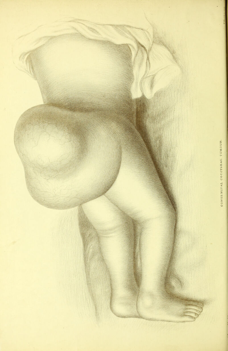 1 c ONGE TsTIT AX/ COCCTGEAX TUMOUR
