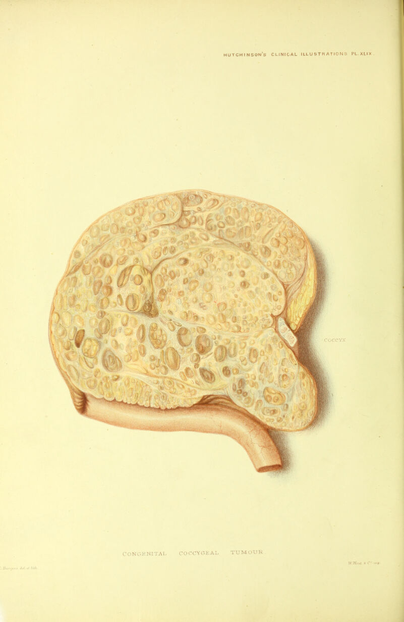 Hutchinson’s clinical illustrations pl.xlix Congenital. coccygeal tumour. •JBu.rcjes.s del. et^ Ulh . W.West wn/3.