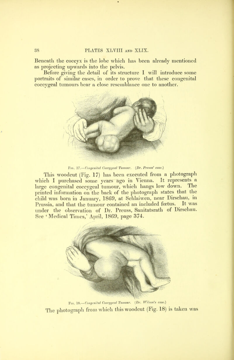 Beneath the coccyx is the lobe which has been already mentioned as projecting upwards into the pelvis. Before giving the detail of its structure I will introduce some portraits of similar cases, in order to prove that these congenital coccygeal tumours bear a close resemblance one to another. Fig. 17.—Congenital Coccygeal Tumour. {Dr. Preuss’ case.) This woodcut (Fig. 17) has been executed from a photograph which I purchased some years ago in Vienna. It represents a large congenital coccygeal tumour, which hangs low down. The printed information on the back of the photograph states that the child was born in January, 1869, at Schlaiwen, near Dirschau, in Prussia, and that the tumour contained an included foetus. It was under the observation of Dr. Preuss, Sanitatsrath of Dirschau. See ^ Medical Times,’ April, 1869, page 374. Fig. is.—Congenital Coccygeal Tumour. {Dr. Wit soil’s case.) The photograph from which this woodcut (Fig. 18) is taken was
