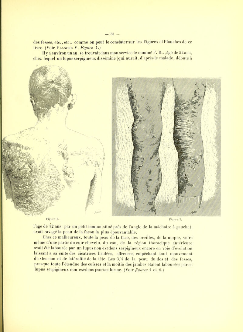 des fesses, etc., etc., comme on peut le constater sur les Figures et Planches de ce livre. (Voir Planche V, Figure 4.) Il y a environ un an, se trouvait dans mon service le nommé F. D..,âgé de 52 ans, chez lequel un lupus serpigineux disséminé (qui aurait, d’après le malade, débuté à l’âge de 32 ans, par un petit bouton silué près de l'angle de la mâchoire à gauche), avait ravagé la peau de la façon la plus épouvantable. Chez ce malheureux, toute la peau de la face, des oreilles, de la nuque, voire même d’une partie du cuir chevelu, du cou, de la région thoracique antérieure avait été labourée par un lupus non exedens serpigineux encore en voie d’évolution laissant à sa suite des cicatrices bridées, affreuses, empêchant tout mouvement d’extension et de latéralité de la tête. Les 3/4 de la peau du dos et des fesses, presque toute l’étendue des cuisses et la moitié des jambes étaient labourées parce lupus serpigineux non exedens psoriasiforme. (Voir figures i et 2.)