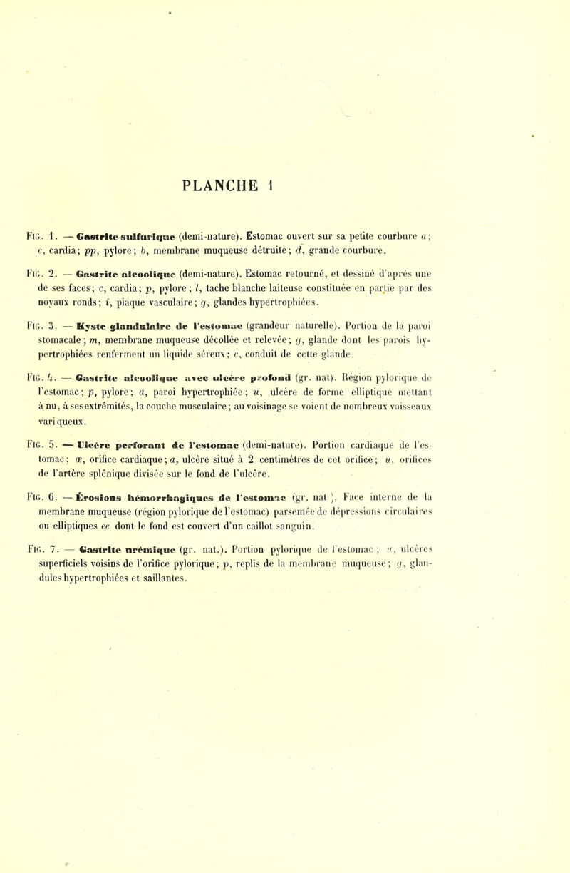 Fig. 1. —Gastrite sulfurique (demi-nature). Estomac ouvert sur sa petite courbure «; c, cardia; pp, pylore; 6, membrane muqueuse détruite; d, grande courbure. Fin. 2. — Gastrite alcoolique (demi-nature). Estomac retourné, et dessiné d'après une de ses faces; c, cardia; p, pylore; /, tache blanche laiteuse constituée en partie par des noyaux ronds; i, piaque vasculaire; g, glandes hypertrophiées. FiG. 3. —Kyste glandulaire de l'estomac (grandeur naturelle). Portion de la paroi stomacale; m, membrane muqueuse décollée et relevée; y, glande dont les parois hy- pertrophiées renferment un liquide séreux; v, conduit de cette glande. FiG. k. — Gastrite alcoolique avec ulcère profond (gr. nat). Région pylorique de l'estomac; p, pylore; a, paroi hypertrophiée; w, ulcère de forme elliptique mettant à nu, à ses extrémités, la couche musculaire ; au voisinage se voient de nombreux vaisseaux variqueux. Fig. 5. —Ulcère perforant de l'estomac (demi-nature). Portion cardiaque de l'es- tomac; œ, orifice cardiaque; a, ulcère situé à 2 centimètres de cet orifice; u, orifices de l'artère splénique divisée sur le fond de l'ulcère. FiG. 6. —Érosions héraorrhagiques de l'estomac (gr. nat ). Face interne de la membrane muqueuse (région pylorique de l'estomac) parsemée de dépressions circulaires ou elliptiques ee dont le fond est couvert d'un caillot sanguin. Fig. 7. — Gastrite nrémique (gr. nat.). Portion pylorique de l'estomac ; u, ulcères superficiels voisins de l'orifice pylorique; p, replis de la membrane muqueuse; ;/, glan- duleshypertrophiées et saillantes.