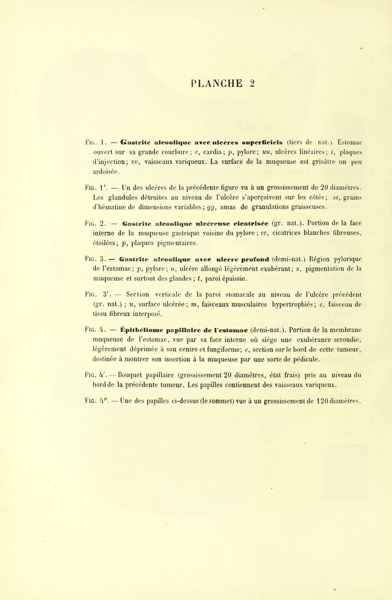 Fig. 1. — Gastrite alcoolique avec ulcères snperGciels (tiers de nat.). Estomac ouvert sur sa grande courbure; c, cardia; p, pylore; uu, ulcères linéaires; i, plaques d'injection; vv, vaisseaux variqueux. La surface de la muqueuse est grisâtre un peu ardoisée. Fig. 1'. — Un des ulcères de la précédente figure vu à un grossissement de 20 diamètres. Les glandules détruites au niveau de l'ulcère s'aperçoivent sur les côtés ; ss, grains d'hématine de dimensions variables; gg, amas de granulations graisseuses. Fig. 2. — Gastrite alcoolique ulcéreuse cicatrisée (gr. nat.). Portion de la face interne de la muqueuse gastrique voisine du pylore; ce, cicatrices blanches fibreuses, étoilées ; p, plaques pigmentaires. Fig. 3. — Gastrite alcoolique avec ulcère profond (demi-nat.) Région pylorique de l'estomac; p, pylore; u, ulcère allongé légèrement exubérant; s, pigmentation de la muqueuse et surtout des glandes ; t, paroi épaissie. Fig. 3'. — Section verticale de la paroi stomacale au niveau de l'ulcère précédent (gr. nat.) ; u, surface ulcérée; m, faisceaux musculaires hypertrophiés; e, faisceau de tissu fibreux interposé. Fig. U. — Épithéliome papillaire de l'estomac (demi-nat.). Portion de la membrane muqueuse de l'estomac, vue par sa face interne où siège une exubérance arrondie, légèrement déprimée à son centre et fungiforme; e, section sur le bord de cette tumeur, destinée à montrer son insertion à la muqueuse par une sorte de pédicule. Fig. k'.— Bouquet papillaire (grossissement 20 diamètres, état frais) pris au niveau du bord de la précédente tumeur. Les papilles contiennent des vaisseaux variqueux. Fig. li. —Une des papilles ci-dessus (le sommet) vue à un grossissement de 120diamètres.