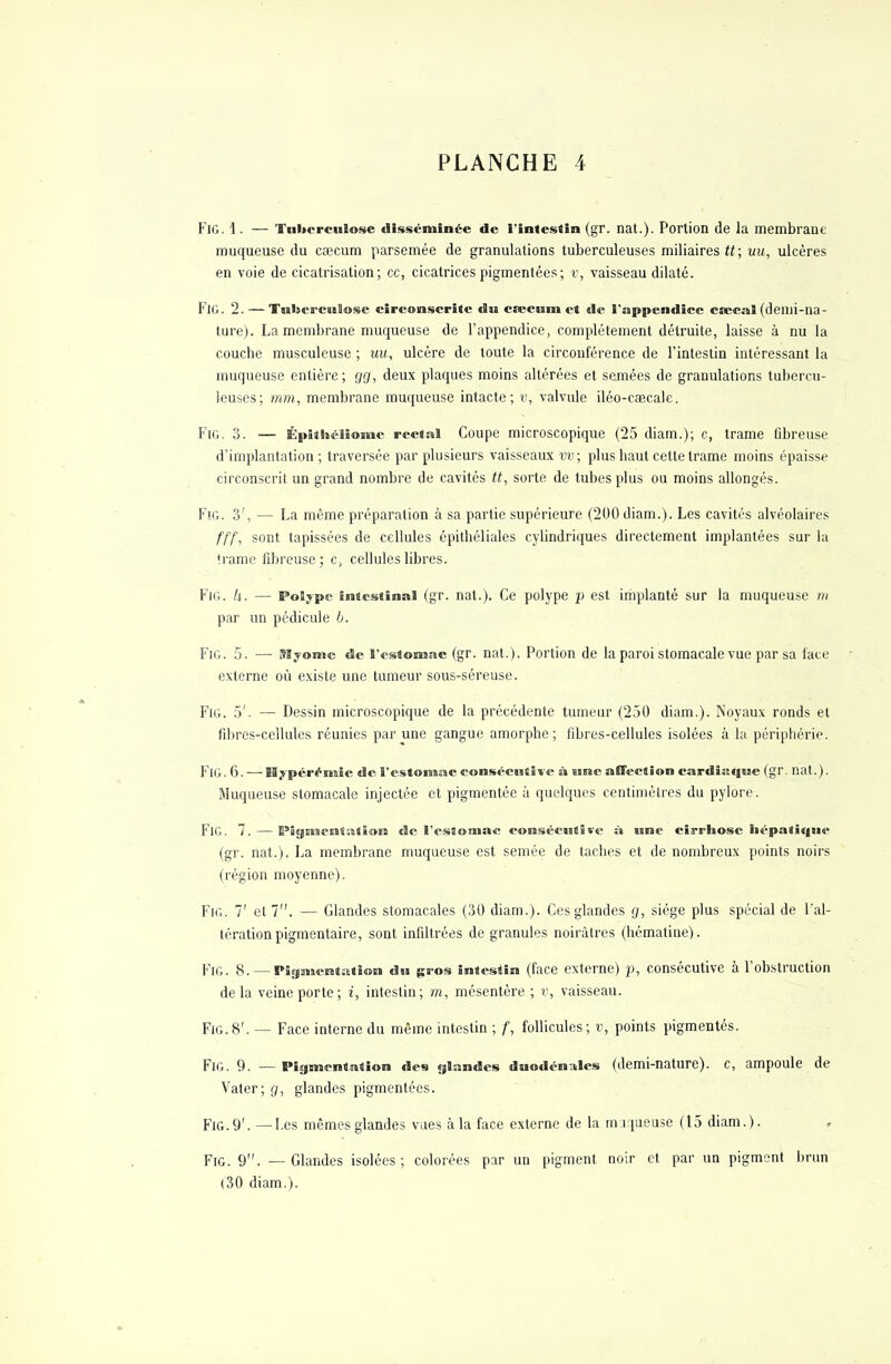 FiG. 1. — Tuberculose disséminée de l'intestin (gr. nat.). Portion de la membrane muqueuse du cœcum parsemée de granulations tuberculeuses miliaires tt; uu, ulcères en voie de cicatrisation; ce, cicatrices pigmentées; t>, vaisseau dilaté. FiG. 2. —Tuberculose circonscrite du etecuin et de l'appendice caecal (demi-na- ture). La membrane muqueuse de l'appendice, complètement détruite, laisse à nù la couche musculeuse ; uu, ulcère de toute la circonférence de l'intestin intéressant la muqueuse entière; gg, deux plaques moins altérées et semées de granulations tubercu- leuses; mm, membrane muqueuse intacte; v, valvule iléo-caecale. Fig. 3. — Épitlîélionic rectal Coupe microscopique (25 diam.); c, trame fibreuse d'implantation ; traversée par plusieurs vaisseaux vv ; plus haut cette trame moins épaisse circonscrit un grand nombre de cavités tt, sorte de tubes plus ou moins allongés. Fig. 3', — La même préparation à sa partie supérieure (200 diam.). Les cavités alvéolaires fff, sont tapissées de cellules épithéliales cylindriques directement implantées sur la trame fibreuse; c, cellules libres. Fig. h. — Polype intestinal (gr. nat.). Ce polype p est implanté sur la muqueuse m par un pédicule b. Fig. 5. — Myomc de l'estomac (gr. nat.). Portion de la paroi stomacale vue par sa face externe où existe une tumeur sous-séreuse. Fig. 5'. — Dessin microscopique de la précédente tumeur (250 diam.). Noyaux ronds et fibres-cellules réunies par une gangue amorphe ; fibres-cellules isolées à la périphérie. FiG. 6. — Hypérémie de l'estomac consécutive à une affection cardiitque (gr. nat.). Muqueuse stomacale injectée et pigmentée à quelques centimètres du pylore. FiG. 7. — Pigmentation de l'estomac consécutive à une cirrhose hépatique (gr. nat.), La membrane muqueuse est semée de taches et de nombreux points noirs (région moyenne). Fig. 7' et 7. — Glandes stomacales (30 diam.). Ces glandes g, siège plus spécial de l'al- tération pigmentaire, sont infiltrées de granules noirâtres (hématine). Fig. 8.—Pigmentation du gros intestin (face externe) p, consécutive à l'obstruction delà veine porte; i, intestin; m, mésentère ; v, vaisseau. Fig.8'. — Face interne du même intestin ; f, follicules; v, points pigmentés. Fig. 9. — Pigmentation des glandes duodén;iles (demi-nature), c, ampoule de Vater; g, glandes pigmentées. Fig.9'. -I.es mêmes glandes vues àla face externe de la maqueuse (15 diam.). Fig. 9. — Glandes isolées; colorées par un pigment noir et par un pigment brun (30 diam.).