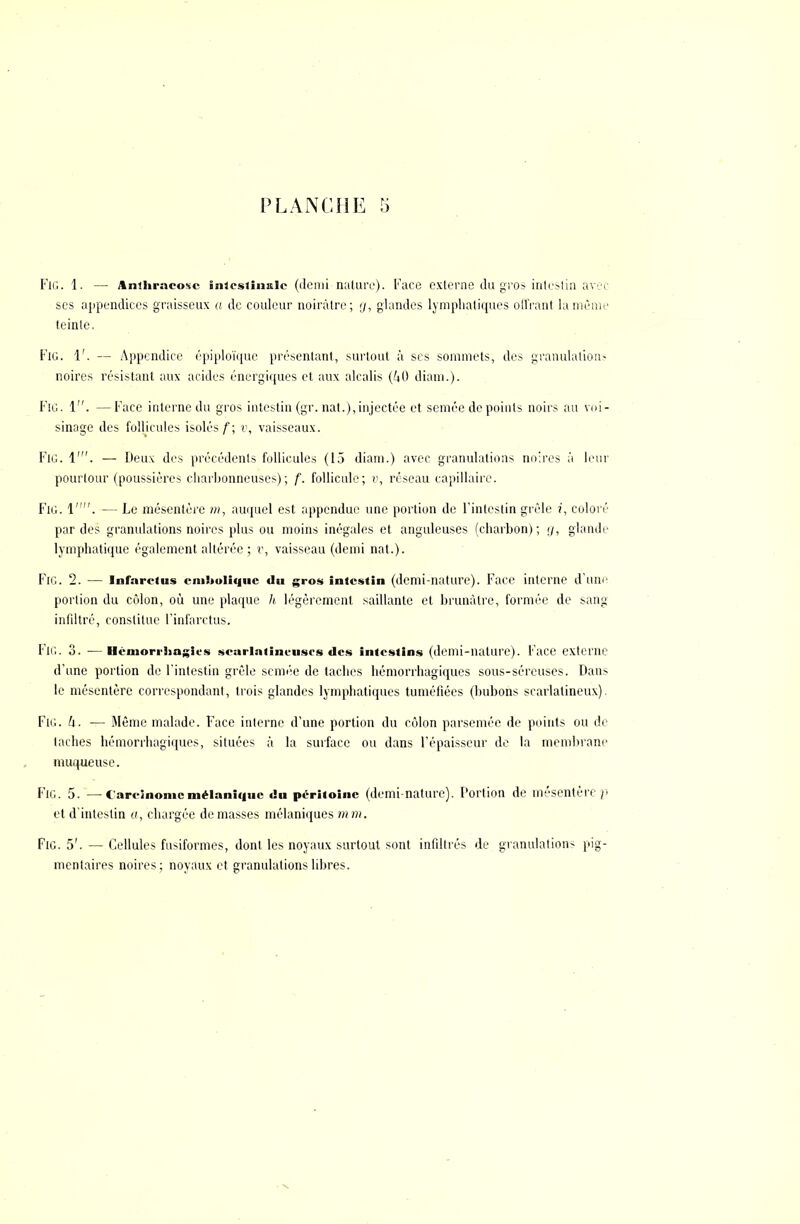 Fie. 1. — Anihraeosc intestinale (ilemi nature). Face externe du gros intestin avec ses appendices graisseux a de couleur noirâtre; rj, glandes lymphatiques offrant la même teinte. FlG. 1'. — Appendice épiploïque présentant, surtout à ses sommets, des granulation- noires résistant aux acides énergiques et aux alcalis (M) diani.). FlG. 1. —Face interne du gros intestin (gr. nat.),injectée et semée de points noirs au voi- sinage des follicules isolés f; v, vaisseaux. FlG. 1'. — Deux des précédents follicules (15 diam.) avec granulations noires à leur pourtour (poussières charbonneuses); f. follicule; v, réseau capillaire. FlG. 1. — Le mésentère m, auquel est. appendue une portion de l'intestin grêle ?', coloré par des granulations noires plus ou moins inégales et anguleuses (charbon); g, glande lymphatique également altérée; v, vaisseau (demi nat.). FiG. 2. — Infarctus cm)>uli<|iic du gros intestin (demi-nature). Face interne d'une portion du colon, où une plaque h légèrement saillante et brunâtre, formée de sang infiltré, constitue l'infarctus. FlG. 3. —Hêmorrhagies scarlaiincuses «les intestins (demi-nature). Face externe d'une portion de l'intestin grêle semée de taches hémorrliagiques sous-séreuses. Dans le mésentère correspondant, trois glandes lymphatiques tuméfiées (bubons scarlatineux) Fig. h. — Même malade. Face interne d'une portion du côlon parsemée de points ou de taches hémorrliagiques, situées à la surface ou dans l'épaisseur de la membrane muqueuse. FlG. 5. —Carcinome mélaniquc du péritoine (demi-nature). Portion de mésentère p et d'intestin a, chargée de masses mélaniques mm. FlG. 5'. — Cellules fusiformes, dont les noyaux surtout sont infiltrés de granulations pig- mentaires noires; noyaux et granulations libres.