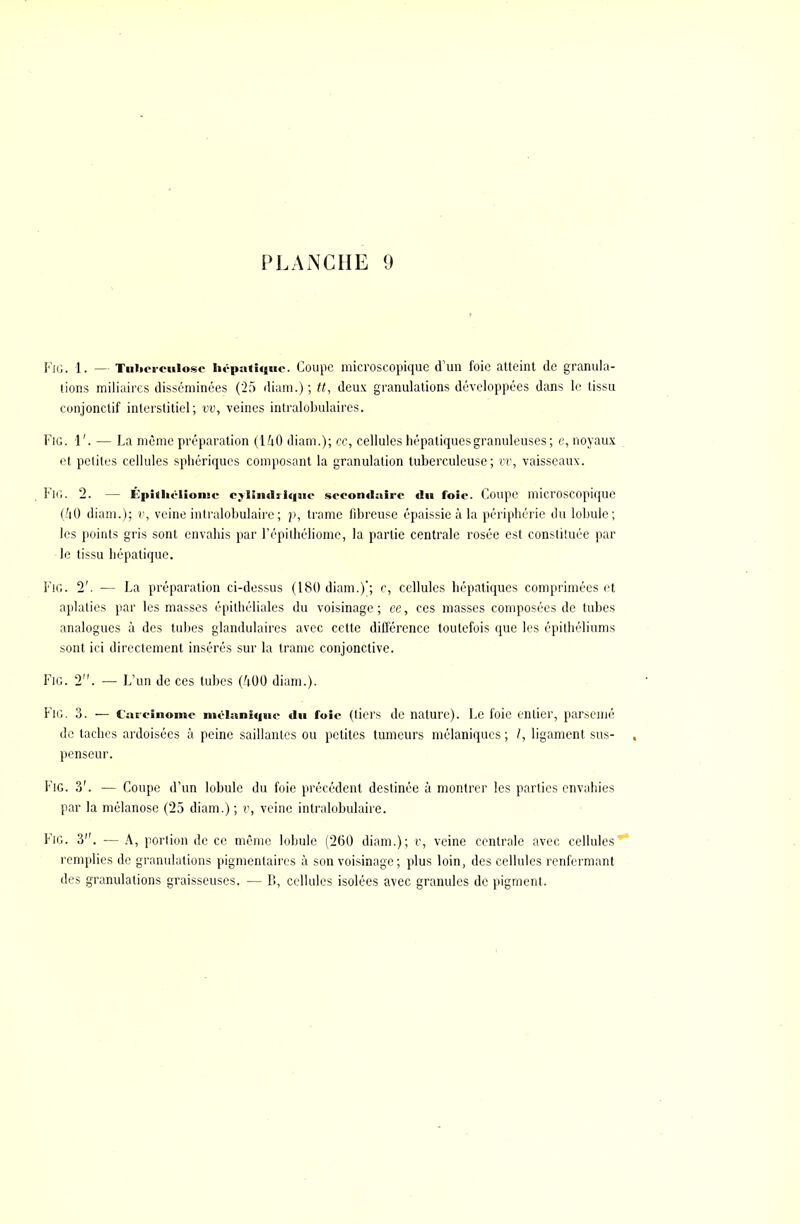 Fig. 1. — Tuberculose hépatique. Coupe microscopique d'un foie atteint de granula- tions miliains disséminées ('25 diam.) ; tt, deux granulations développées dans le tissu conjonclif interstitiel; m, veines intralobulaires. Fig. 1'. — La même préparation (L'iO diam.); ce, cellules hépatiquesgranuleuses ; c, noyaux et petites cellules sphériques composant la granulation tuberculeuse; vv, vaisseaux. FlG. 2. — ïvpithélionie cylindrique secondaire «lu foie. Coupe microscopique UiO diam.); v, veine intralobulaire; }>, trame fibreuse épaissie à la périphérie du lobule; les points gris sont envahis par l'épilhéliome, la partie centrale rosée est constituée par le tissu hépatique. FlG. 2'. — La préparation ci-dessus (180 diam.)'; c, cellules hépatiques comprimées et aplaties par les masses épilhéliales du voisinage; ce, ces masses composées de tubes analogues à des tubes glandulaires avec cette différence toutefois que les épithéliums sont ici directement insérés sur la trame conjonctive. Fig. 2. — L'un de ces tubes (/|00 diam.). Fig. 3. — Carcinome mcluniquc du foie (tiers de nature). Le foie entier, parsemé de taches ardoisées à peine saillantes ou petites tumeurs mélaniques ; I, ligament sus- , penseur. FlG. 3'. — Coupe d'un lobule du foie précédent destinée à montrer les parties envahies par la mélanose (25 diam.) ; v, veine intralobulaire. Fig. 3. — A, portion de ce même lobule (260 diam.); c, veine centrale avec cellules remplies de granulations pigmentahos à son voisinage; plus loin, dos cellules renfermant des granulations graisseuses. — B, cellules isolées avec granules de pigment.