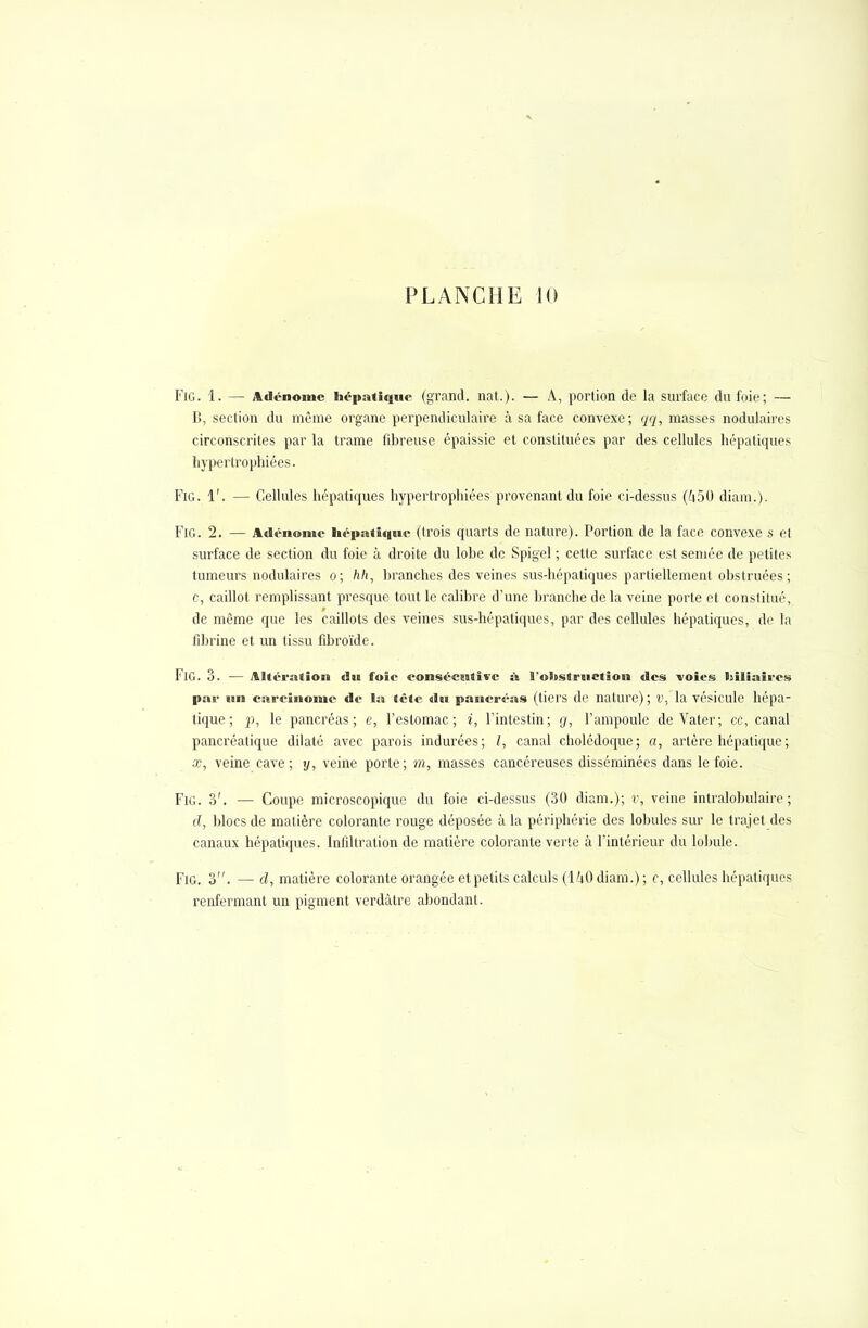 FlG. 1. — Adénome hépatique (grand, nat.). — À, portion de la surface du foie; — B, section du même organe perpendiculaire à sa face convexe; qq, masses nodulaires circonscrites par la trame fibreuse épaissie et constituées par des cellules hépatiques hypertrophiées. FlG. 1'. — Cellules hépatiques hypertrophiées provenant du foie ci-dessus (450 diam.). Fig. 2. — Adénome hépatique (trois quarts de nature). Portion de la face convexe s et surface de section du foie à droite du lobe de Spigel ; cette surface est semée de petites tumeurs nodulaires o; hh, branches des veines sus-hépaliques partiellement obstruées; c, caillot remplissant presque tout le calibre d'une branche de la veine porte et constitué, de même que les caillots des veines sus-hépaliques, par des cellules hépatiques, de la fibrine et un tissu fibroïde. FlG. 3. — Altération du foie consécutive à 9'ohstriiction des voies biliaires pas- un carcinome de la tète du pancréas (tiers de nature) ; v, la vésicule hépa- tique ; p, le pancréas; e, l'estomac; i, l'intestin; g, l'ampoule de Vater; ce, canal pancréatique dilaté avec parois indurées; /, canal cholédoque; a, artère hépatique; x, veine cave; y, veine porte; m, masses cancéreuses disséminées dans le foie. Fig. 3'. — Coupe microscopique du foie ci-dessus (30 diam.); v, veine intralobulaire ; cf, blocs de matière colorante rouge déposée h la périphérie des lobules sur le trajet des canaux hépatiques. Infiltration de matière colorante verte à l'intérieur du lobule. Fig. 3. — d, matière colorante orangée et petits calculs (140 diam.); c, cellules hépatiques renfermant un pigment vcrdàlrc abondant.