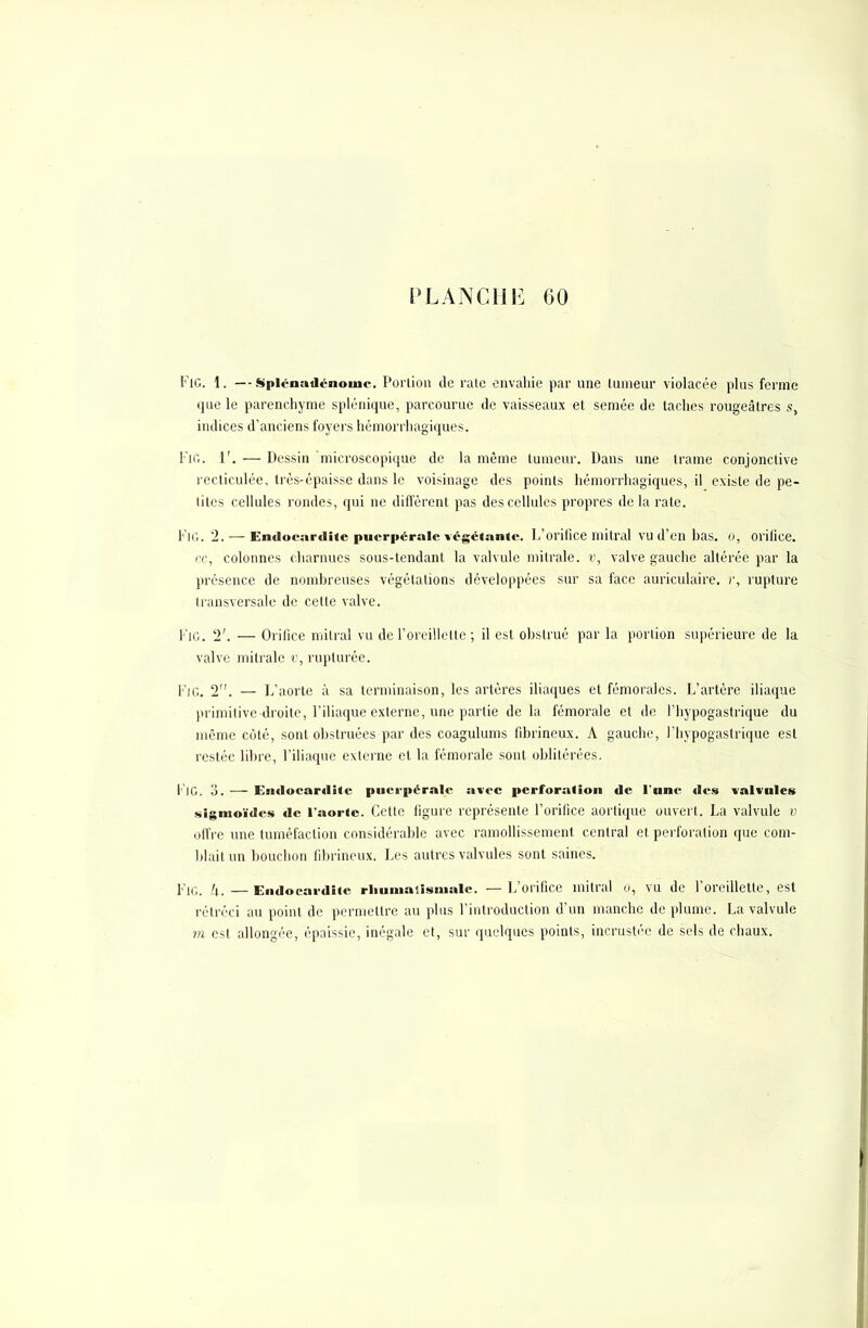 FlG. 1. —Splénudénouic. Porlion de rate envahie par une tumeur violacée plus ferme que le parenchyme splénique, parcourue de vaisseaux et semée de taches rougeâtres s, indices d'anciens hivers héinorrliagiques. l'io. 1'. — Dessin microscopique de la même tumeur. Dans une trame conjonctive recticulée, très-épaisse dans le voisinage des points hémorrhagiques, il existe de pe- tites cellules rondes, qui ne diffèrent pas des cellules propres de la rate. VlG. 2.— Endocardite puerpérale végétante. L'orifice mitral vu d'en bas. o, orifice, ce, colonnes charnues sous-tendant la valvule milrale. v, valve gauche altérée par la présence de nombreuses végétations développées sur sa face auriculaire, r, rupture transversale de cette valve. Fig. 2'. — Orifice mitral vu de l'oreillette ; il est obstrué par la portion supérieure de la valve mitrale v, rupturée. Fjg. 2. — L'aorte à sa terminaison, les artères iliaques et fémorales. L'artère iliaque primitive-droite, l'iliaque externe, une partie de la fémorale et de l'hypogastrique du même côté, sont obstruées par des coagulums fibrineux. A gauche, l'hypogastrique est restée libre, l'iliaque externe et la fémorale sont oblitérées. I IG. o. — Endocartlite puerpérale avec perforation de l'une des valvules sigmoïdes de Taoric. Cette figure représente l'orifice aortique ouvert. La valvule v offre une tuméfaction considérable avec ramollissement central et perforation que com- blait un bouchon fibrineux. Les autres valvules sont saines. IV,. h.—Endocardite rhumatismale. — L'orifice mitral o, vu de l'oreillette, est rétréci au point de permettre au plus l'introduction d'un manche de plume. La valvule m est allongée, épaissie, inégale et, sur quelques points, incrustée de sels de chaux.