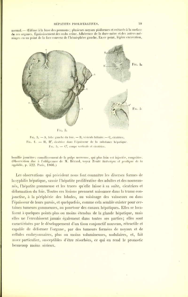 normal.— Œdème à la hase des poumons ; plusieurs noyaux pisiformes et crétacés à la surface d< ces organes. Épaississement des osdu crâne. Adhérence de la dure-mère et des autres mé- ninges en un point de la face convexe de l’hémisphère gauche. En ce point, légère excavation, Fig. 3. Fig. 3. —A, lobe gauche du l'oie. — R, vésicule biliaire.— C, cicatrice. Fig. h. — H, IF, cicatrice dans l’épaisseur de la substance hépatique. Fig. 5. — C', coupe verticale et cicatrice. bouillie jaunâtre; ramollissement de la pulpe nerveuse, qui plus loin est injectée, rougeâtre. (Observation due à l’obligeance de M. Hérard, voyez Traité historique et pratique cle la syphilis, p. 322. Paris, l<S(i6.) Les observations qui précèdent nous font connaître les diverses formes de la syphilis hépatique, savoir l’hépatite proliférative des adultes et des nouveau- nés, l’hépatite gommeuse et les traces qu’elle laisse à sa suite, cicatrices et déformation du foie. Toutes ces lésions prennent naissance dans la trame con- jonctive, à la périphérie des lobules, au voisinage des vaisseaux ou dans l’épaisseur de leurs parois, et quelquefois, comme cela semble exister pour cer- taines tumeurs gommeuses, au pourtour des canaux hépatiques. Elles se loca- lisent à quelques points plus ou moins étendus de la glande hépatique, mais elles ne l’envahissent jamais également dans toutes ses parties; elles sont caractérisées par le développement d’un tissu conjonctif nouveau, rétractile et capable de déformer l’organe, par des tumeurs formées de noyaux et de cellules embryonnaires, plus ou moins volumineuses, nodulaires, et, fait assez particulier, susceptibles d’être résorbées, ce qui en rend le pronostic beaucoup moins sérieux.