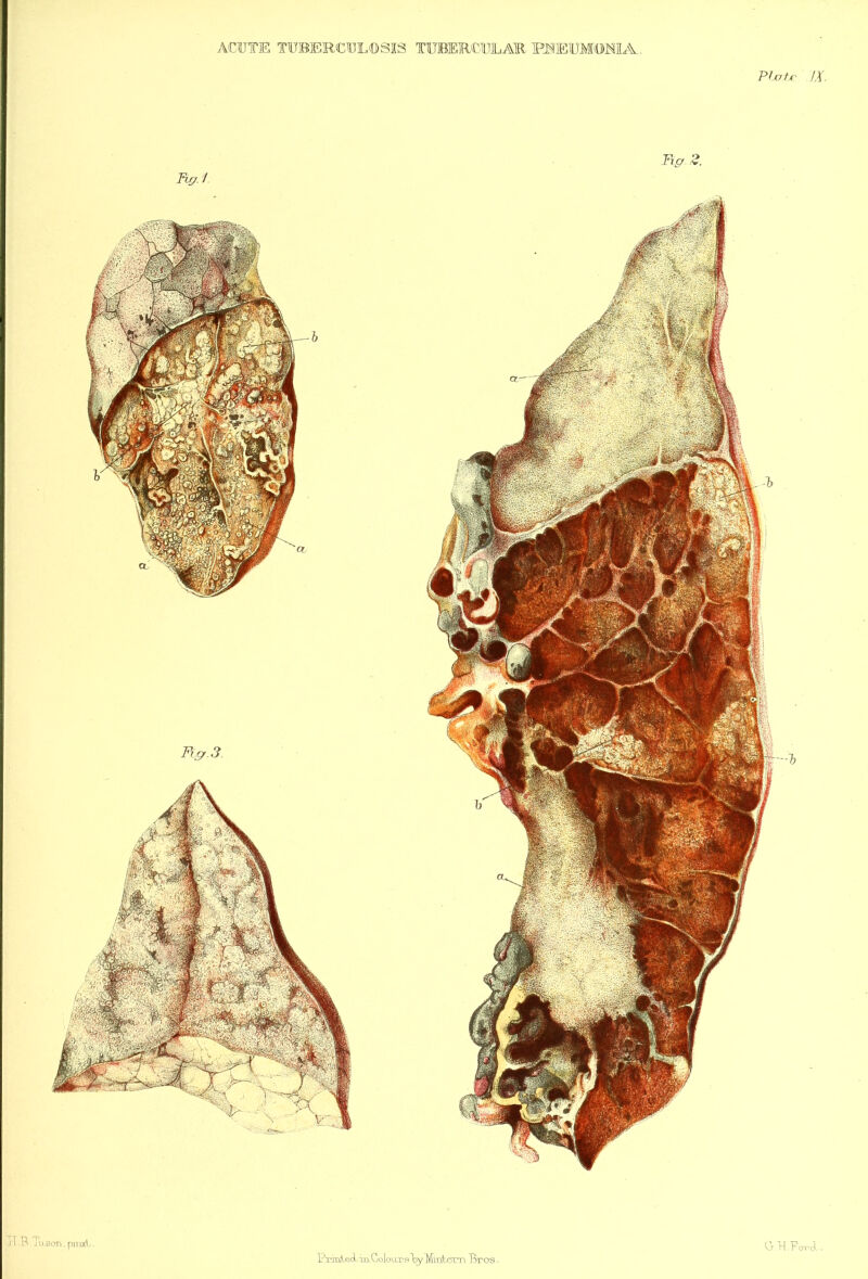 ACUTE TUBERCULOSIS TUBERCULAR FSEUMONIA. PJjOtf' JX. Bv! Bp. 3. Bg 2. IB ju5on,piii:d.. iVialed-irLCoioaTslDy lYliaVi^rn Bros. O TI.Forc^