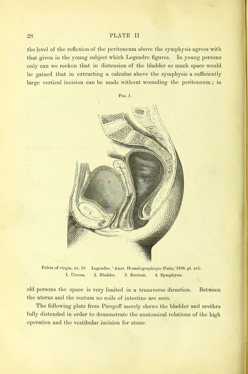 tlie level of the reflexion of the peritoneum above the symphysis agrees with that given in the young subject which Legendre figures. In young persons only can we reckon that in distension of the bladder so much space would be gained that in extracting a calculus above the symphysis a sufficiently large vertical incision can be made without wounding the peritoneum; in Fig. 1. Pelvis of virgin, set. 18. Legendre, ‘ Anat. Homalographique Paris,’ 1868, pi. xvii. 1. Uterus. 2. Bladder. 3. Rectum. 4. Symphysis. old persons the space is very limited in a transverse direction. Between the uterus and the rectum no coils of intestine are seen. The following plate from Pirogoff merely shows the bladder and urethra fully distended in order to demonstrate the anatomical relations of the high operation and the vestibular incision for stone.
