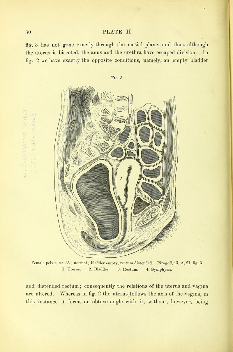 fig. 3 has not gone exactly through the mesial plane, and thus, although the uterus is bisected, the anus and the urethra have escaped division. In fig. 2 we have exactly the opposite conditions, namely, an empty bladder Fig. 3. Female pelvis, let. 35 ; normal; bladder empty, rectum distended. Pirogoff, iii, A, 21, fig. 3. 1. Uterus. 2. Bladder. 3. Rectum. 4. Symphysis. and distended rectum; consequently the relations of the uterus and vagina are altered. Whereas in fig. 2 the uterus follows the axis of the vagina, in this instance it forms an obtuse angle with it, without, however, being