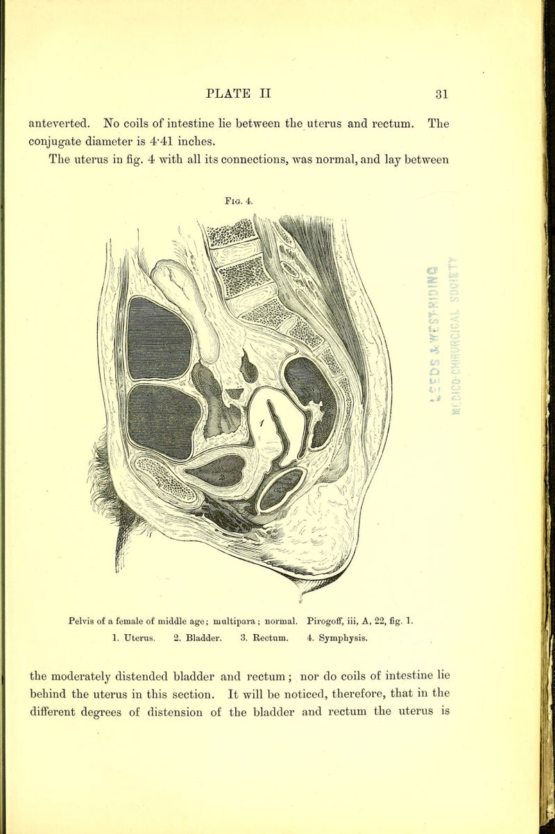 anteverted. No coils of intestine lie between the uterus and rectum. The conjugate diameter is 4*41 inches. The uterus in fig. 4 with all its connections, was normal, and lay between Fig. 4. Pelvis of a female of middle age; multipara ; normal. Pirogoff, iii, A, 22, fig. 1. 1. Uterus. 2. Bladder. 3. Rectum. 4. Symphysis. the moderately distended bladder and rectum ; nor do coils of intestine lie behind the uterus in this section. It will be noticed, therefore, that in the different degrees of distension of the bladder and rectum the uterus is