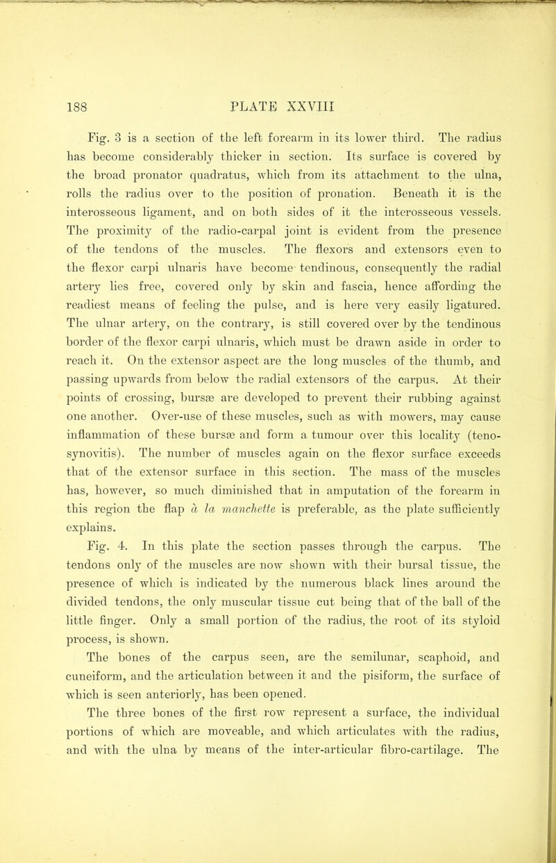 ...— 188 PLATE XXVIII Fig. 3 is a section of the left forearm in its lower third. The radius has become considerably thicker in section. Its surface is covered by the broad pronator quadratus, which from its attachment to the ulna, rolls the radius over to the position of pronation. Beneath it is the interosseous ligament, and on both sides of it the interosseous vessels. The proximity of the radio-carpal joint is evident from the presence of the tendons of the muscles. The flexors and extensors even to the flexor carpi ulnaris have become- tendinous, consequently the radial artery lies free, covered only by skin and fascia, hence affording the readiest means of feeling the pulse, and is here very easily ligatured. The ulnar artery, on the contrary, is still covered over by the tendinous border of the flexor carpi ulnaris, which must be drawn aside in order to reach it. On the extensor aspect are the long muscles of the thumb, and passing upwards from below the radial extensors of the carpus. At their points of crossing, bursae are developed to prevent their rubbing against one another. Over-use of these muscles, such as with mowers, may cause inflammation of these bursas and form a tumour over this locality (teno- synovitis). The number of muscles again on the flexor surface exceeds tlmt of the extensor surface in this section. The mass of the muscles has, however, so much diminished that in amputation of the forearm in this region the flap a la manchette is preferable, as the plate sufficiently explains. Fig. 4. In this plate the section passes through the carpus. The tendons only of the muscles are now shown with their bursal tissue, the presence of which is indicated by the numerous black lines around the divided tendons, the only muscular tissue cut being that of the ball of the little finger. Only a small portion of the radius, the root of its styloid process, is shown. The bones of the carpus seen, are the semilunar, scaphoid, and cuneiform, and the articulation between it and the pisiform, the surface of which is seen anteriorly, has been opened. The three bones of the first row represent a surface, the individual portions of which are moveable, and which articulates with the radius, and with the ulna by means of the inter-articular fibro-cartilage. The