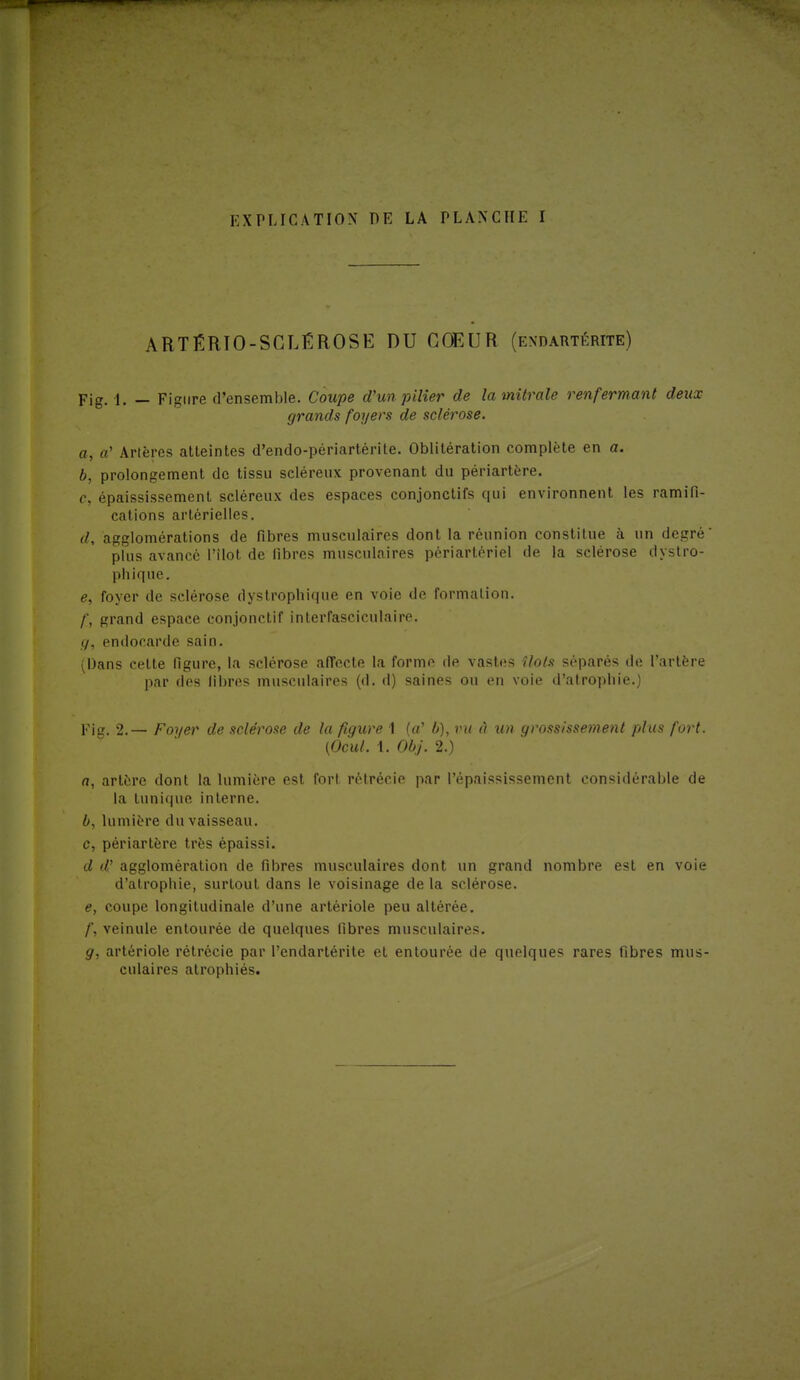 ARTÉRIOSCLÉROSE DU CŒUR (endartérite) Fig. 1. — Figure d'ensemble. Coupe d'un pilier de lamitrale renfermant deux grands foyers de sclérose. a, a' Artères atteintes d'endo-périartérite. Oblitération complète en a. b, prolongement de tissu scléreux provenant du périartère. c, épaississement scléreux des espaces conjonctifs qui environnent les ramifi- cations artérielles. d, agglomérations de fibres musculaires dont la réunion constitue à un degré' plus avancé l'îlot de fibres musculaires périartériel de la sclérose dystro- phique. e, foyer de sclérose dystrophique en voie de formation. /', grand espace conjonctif interfasciculaire. </, endocarde sain. (Dans cette figure, la sclérose affecte la forme de vastes îlots séparés de l'artère par des libres musculaires (d. d) saines ou en voie d'atrophie.) Figi 2.— Foyer de sclérose de la figure 1 («' b), vu à un grossissement plus fort. (Ocul. 1. Obj. 2.) a, artère dont la lumière est fort rétrécie par l'épaississement considérable de la tunique interne. b, lumière du vaisseau. c, périartère très épaissi. d d'agglomération de fibres musculaires dont un grand nombre est en voie d'atrophie, surtout dans le voisinage de la sclérose. e, coupe longitudinale d'une artériole peu altérée. f, veinule entourée de quelques fibres musculaires. g, artériole rétrécie par l'endartérite et entourée de quelques rares fibres mus- culaires atrophiés.