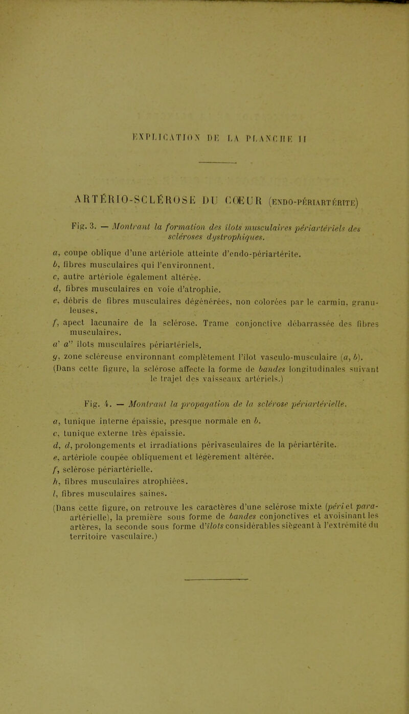 I KPLICATIOIS DE LA l'I. wciii m Â.RTÉRIO-SCLËROSE DU CŒUR endo-périartirrite) Fig. 3. — Montrant la formation des Ilots musculaires périarlériels de» stieroses dgstrophiques. o, coupe oblique d'une artériole atteinte d'endo-périartérite. b, fibres musculaires qui l'environnent. c, autre artériole également altérée. d, libres musculaires en voie d'atrophie. e, débris de fibres musculaires dégénérées, non colorées par le carmin, granu- leuses. f, apect lacunaire de la sclérose. Trame conjonctive débarrassée des fibres musculaires. a' a îlots musculaires périarlériels. g, zone scléreuse environnant complètement l'ilot vasculo-musculaire o, b). (Dans cette figure, la sclérose affecte la forme de bandes longitudinales suivant le trajel de- vaisseaux artériels.) Fig. 4. — Montrant la propagation de la sclérose périarlérielle, a, tunique interne épaissie, presque normale en b, c. tunique externe Lrès épaissie. d, d, prolongements et irradiations périvasculaires de la périartérite. f, artériole coupée obliquement et légèrement altérée. /', sclérose périartérielle. h, fibres musculaires atrophiées. /, fibres musculaires saines. (Dans cette figure, on retrouve les caractères d'une sclérose mixte (périel para- artérielle), la première sous forme de bandes conjonctives et avoisinant les artères, la seconde sous forme ù'îlols considérables siégeant à l'extrémité du territoire vasculaire.)