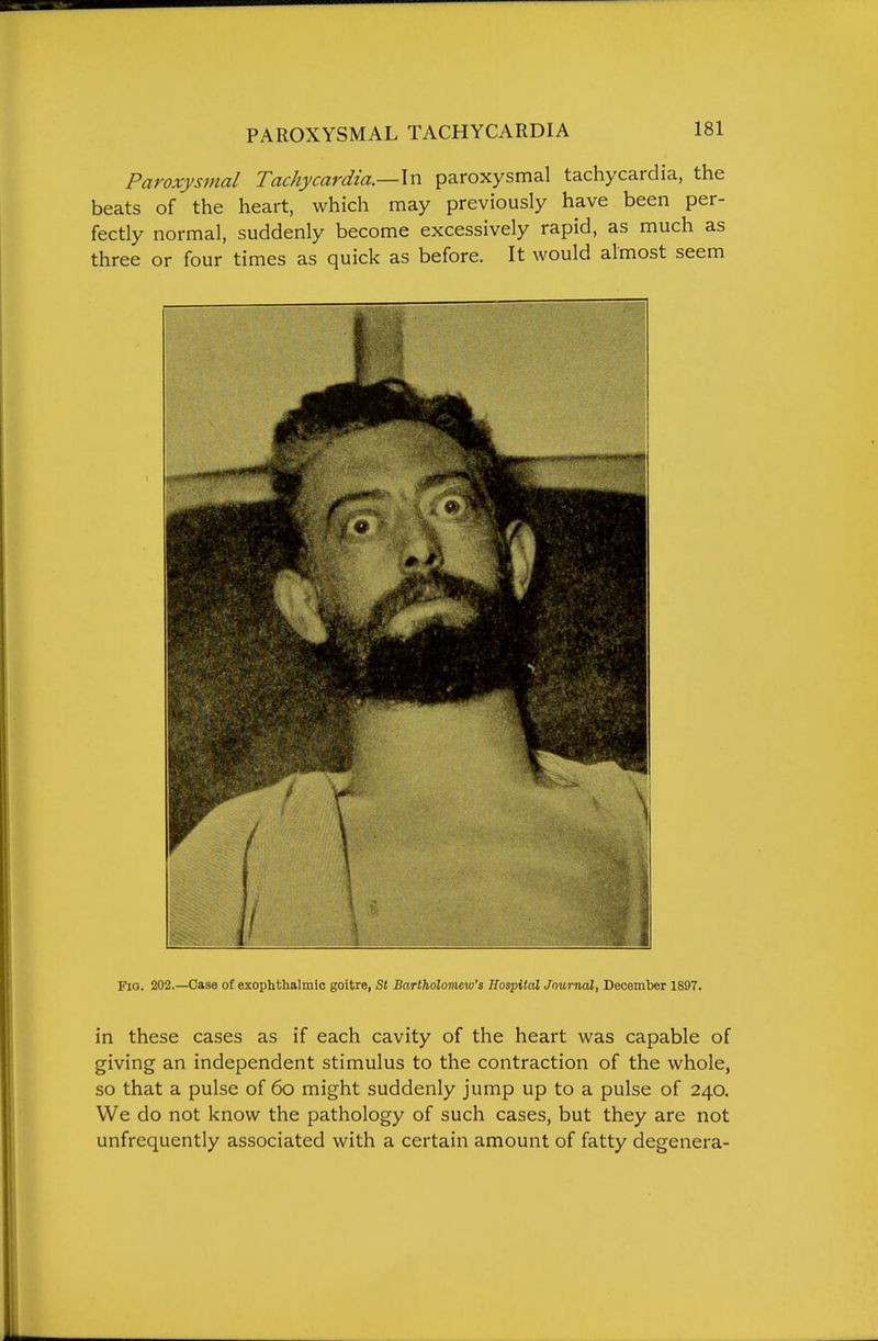 Paroxysmal Tachycardia,—In paroxysmal tachycardia, the beats of the heart, which may previously have been per- fectly normal, suddenly become excessively rapid, as much as three or four times as quick as before. It would almost seem Fia. 202.—Case of exophthalmic goitre, Si Bartholomew's Hospital Journal, December 1897. in these cases as if each cavity of the heart was capable of giving an independent stimulus to the contraction of the whole, so that a pulse of 60 might suddenly jump up to a pulse of 240. We do not know the pathology of such cases, but they are not unfrequently associated with a certain amount of fatty degenera-