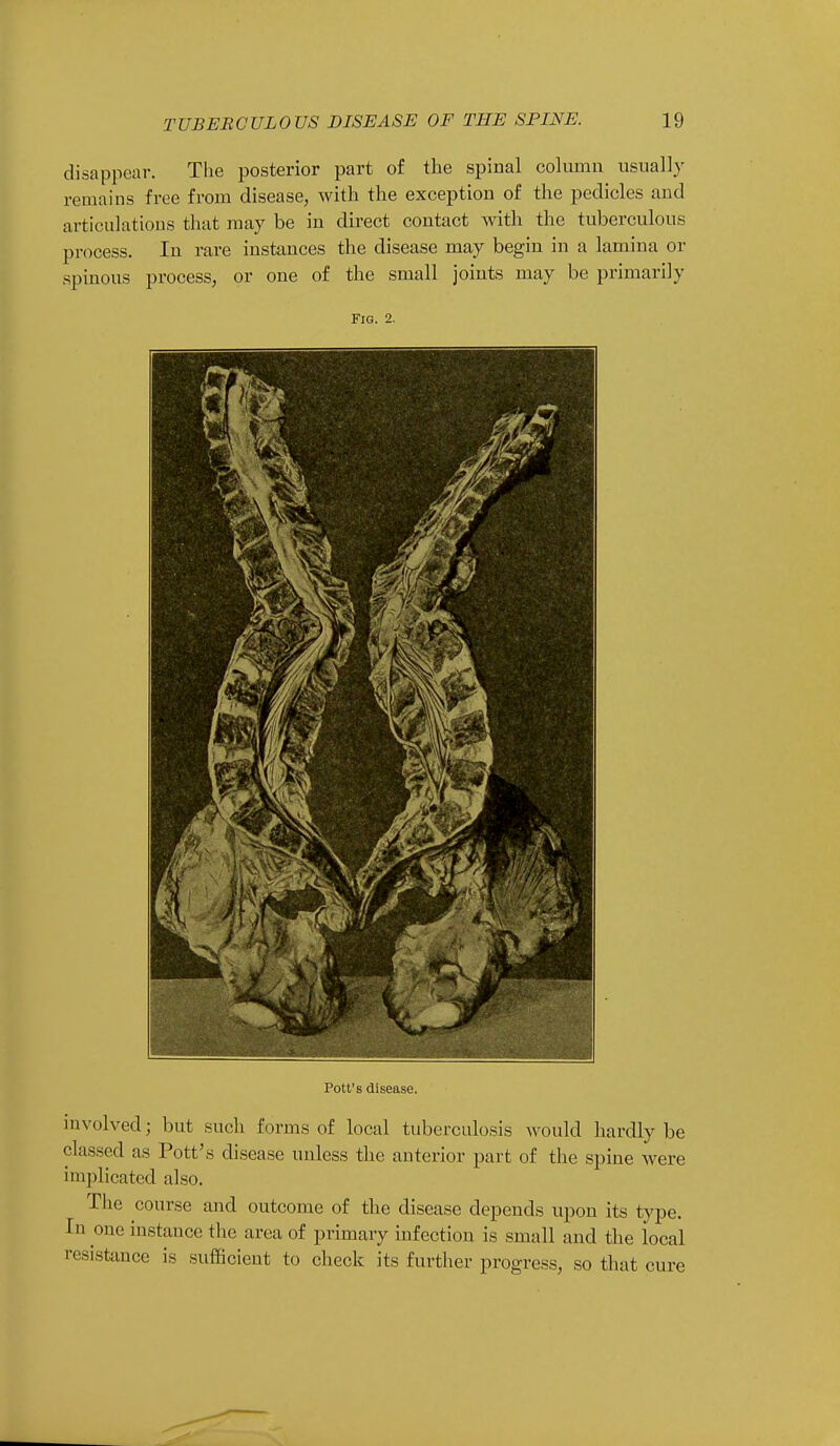 disappear. The posterior part of the spinal column usually remains free from disease, with the exception of the pedicles and articulations that may be in direct contact with the tuberculous process. In rare instances the disease may begin in a lamina or spinous process, or one of the small joints may be primarily Fig. 2. Pott's disease. involved; but such forms of local tuberculosis would hardly be classed as Pott's disease unless the anterior part of the spine were implicated also. The course and outcome of the disease depends upon its type. In one instance the area of primary infection is small and the local resistance is sufficient to check its further progress, so that cure