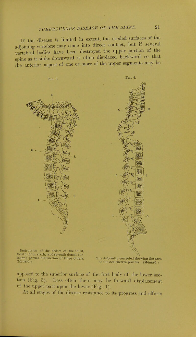 If the disease is limited in extent, the eroded surfaces of the adjoining vertebra may come into direct contact, but if several vertebral bodies have been destroyed the upper portion of the spine as it sinks downward is often displaced backward so that the anterior aspect of one or more of the upper segments may be Fig. 3. D Destruction of the bodies of the third, fourth, fifth, sixth, and seventh dorsal ver- tebrae ; partial destruction of three others. (M6nard.) Fig. 4. The deformity corrected showing the area of the destructive process (M6nard.) apposed to the superior surface of the first body of the lower sec- tion (Fig. 3). Less often there may be forward displacement of the upper part upon the lower (Fig. 1). At all stages of the disease resistance to its progress and efforts