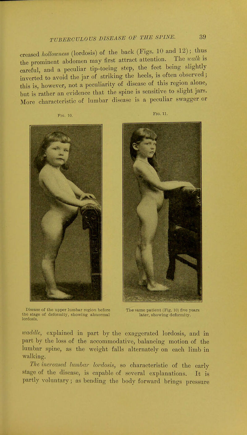 creased hollowness (lordosis) of the back (Figs. 10 and 12); thus the prominent abdomen may first attract attention. The walk is careful, and a peculiar tip-toeing step, the feet being slightly inverted to avoid the jar of striking the heels, is often observed; this is, however, not a peculiarity of disease of this region alone, but is rather an evidence that the spine is sensitive to slight jars. More characteristic of lumbar disease is a peculiar swagger or Frr,. 10. Fig. 11. Disease of the upper lumbar region before the stage of deformity, showing abnormal lordosis. The Fame patient (Fig. 10) five years later, showing deformity. waddle, explained in part by the exaggerated lordosis, and in part by the loss of the accommodative, balancing motion of the lumbar spine, as the weight falls alternately on each limb in walking. The increased lumbar lordosis, so characteristic of the early stage of the disease, is capable of several explanations. It is partly voluntary; as bending the body forward brings pressure