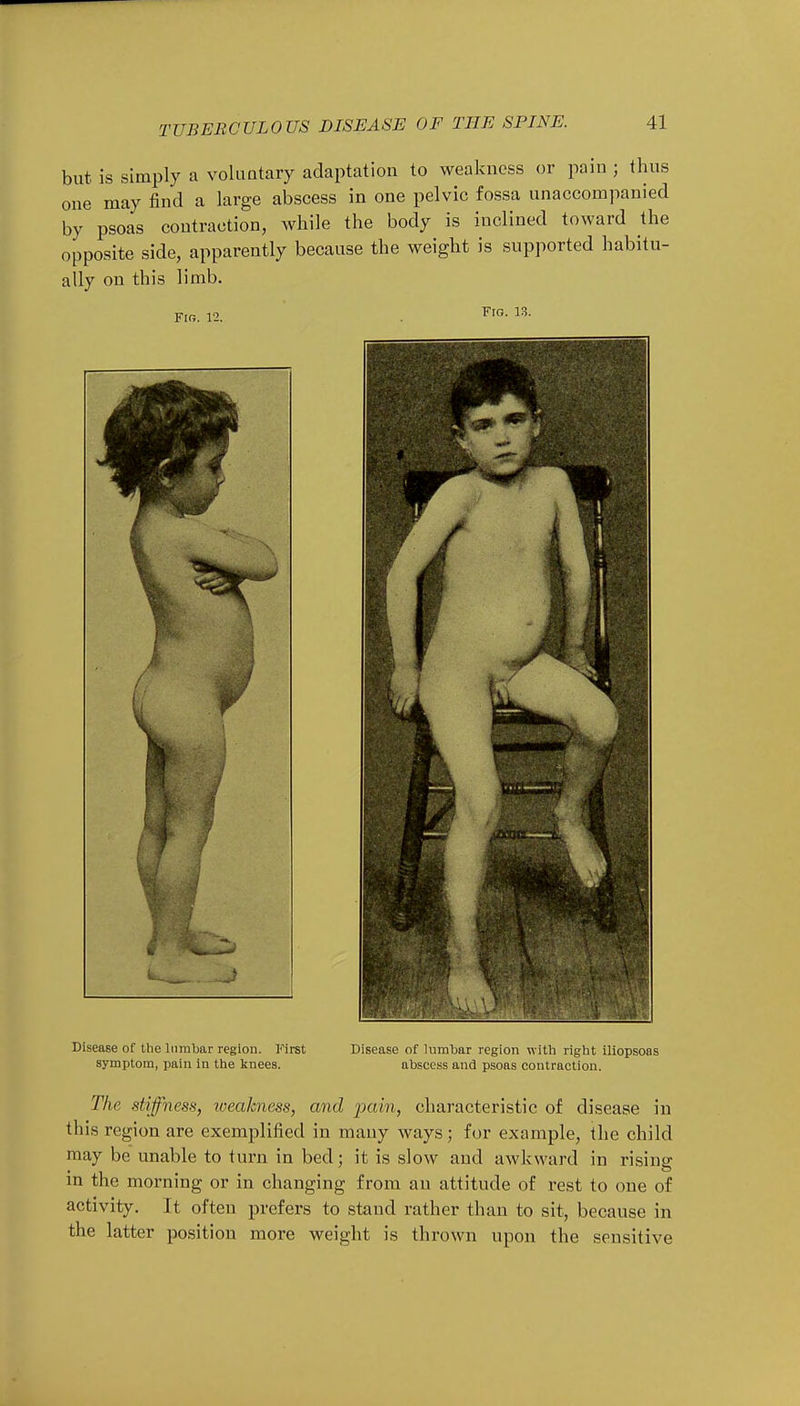 but is simply a voluntary adaptation to weakness or pain j thus one may find a large abscess in one pelvic fossa unaccompanied by psoas contraction, while the body is inclined toward the opposite side, apparently because the weight is supported habitu- ally on this limb. Fig. 12. Fig. 13. Disease of the lumbar region. First symptom, pain in the knees. Disease of lumbar region with right iliopsoas abscess and psoas contraction. The stiffness, weakness, and pain, characteristic of disease in tliis region are exemplified in many ways; for example, the child may be unable to turn in bed; it is slow and awkward in rising in the morning or in changing from an attitude of rest to one of activity. It often prefers to stand rather than to sit, because in the latter position more weight is thrown upon the sensitive