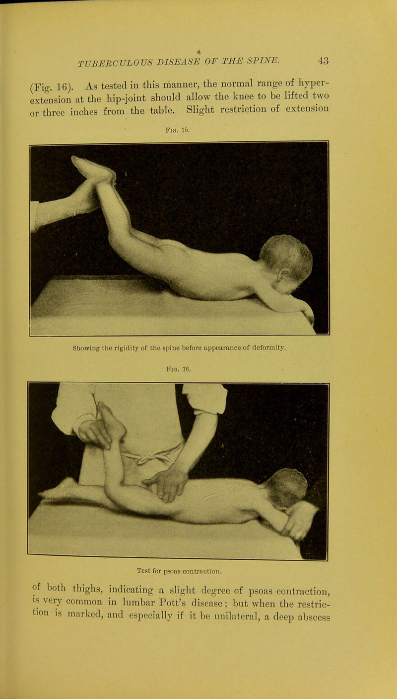 TUBERCULOUS DISEASE OF THE SPINE. 43 (Fig. 16). As tested in this manner, the normal range of hyper- extension at the hip-joint should allow the knee to be lifted two or three inches from the table. Slight restriction of extension Fig. 15. Showing the rigidity of the spine before appearance of deformity. Fig. 16. Test for psoas contraction. of both thighs, indicating a slight degree of psoas contraction, W very common in lumbar Pott's disease; but when the restric- tion is marked, and especially if it be unilateral, a deep abscess