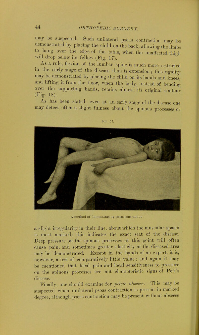 II may be suspected. Such unilateral psoas contraction may be demonstrated by placing the child on the back, allowing the limbs to hang over the edge of the table, when the unaffected thigh will drop below its fellow (Fig. 17). As a rule, flexion of the lumbar spine is much more restricted in the early stage of the disease than is extension; this rigidity may be demonstrated by placing the child on its hands and knees, and lifting it from the floor, when the body, instead of bending over the supporting hands, retains almost its original contour (Fig. 18). As has been stated, even at an early stage of the disease one may detect often a slight fulness about the spinous processes or Fin. 17 A method of demonstrating psoas contraction. a slight irregularity in their line, about which the muscular spasm is most marked; this indicates the exact seat of the disease. Deep pressure on the spinous processes at this point will often cause pain, and sometimes greater elasticity at the diseased area may be demonstrated. Except in the hands of an expert, it is, however, a test of comparatively little value; and again it may be mentioned that local pain and local sensitiveness to pressure on the spinous processes are not characteristic signs of Pott's disease. Finally, one should examine for pelvic abscess. This may be suspected when unilateral psoas contraction is present in marked degree, although psoas contraction may be present without abscess