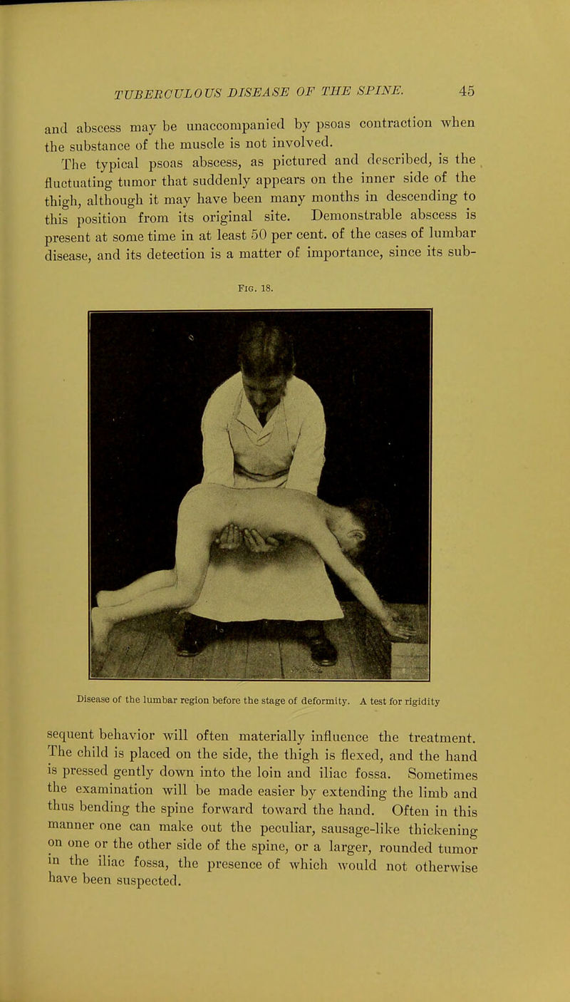 and abscess may be unaccompanied by psoas contraction when the substance of the muscle is not involved. The typical psoas abscess, as pictured and described, is the fluctuating tumor that suddenly appears on the inner side of the thigh, although it may have been many months in descending to this position from its original site. Demonstrable abscess is present at some time in at least 50 per cent, of the cases of lumbar disease, and its detection is a matter of importance, since its sub- Fig. 18. Disease of the lumbar region before the stage of deformity. A test for rigidity sequent behavior will often materially influence the treatment. The child is placed on the side, the thigh is flexed, and the hand is pressed gently down into the loin and iliac fossa. Sometimes the examination will be made easier by extending the limb and thus bending the spine forward toward the hand. Often in this manner one can make out the peculiar, sausage-like thickening on one or the other side of the spine, or a larger, rounded tumor in the iliac fossa, the presence of which would not otherwise have been suspected.