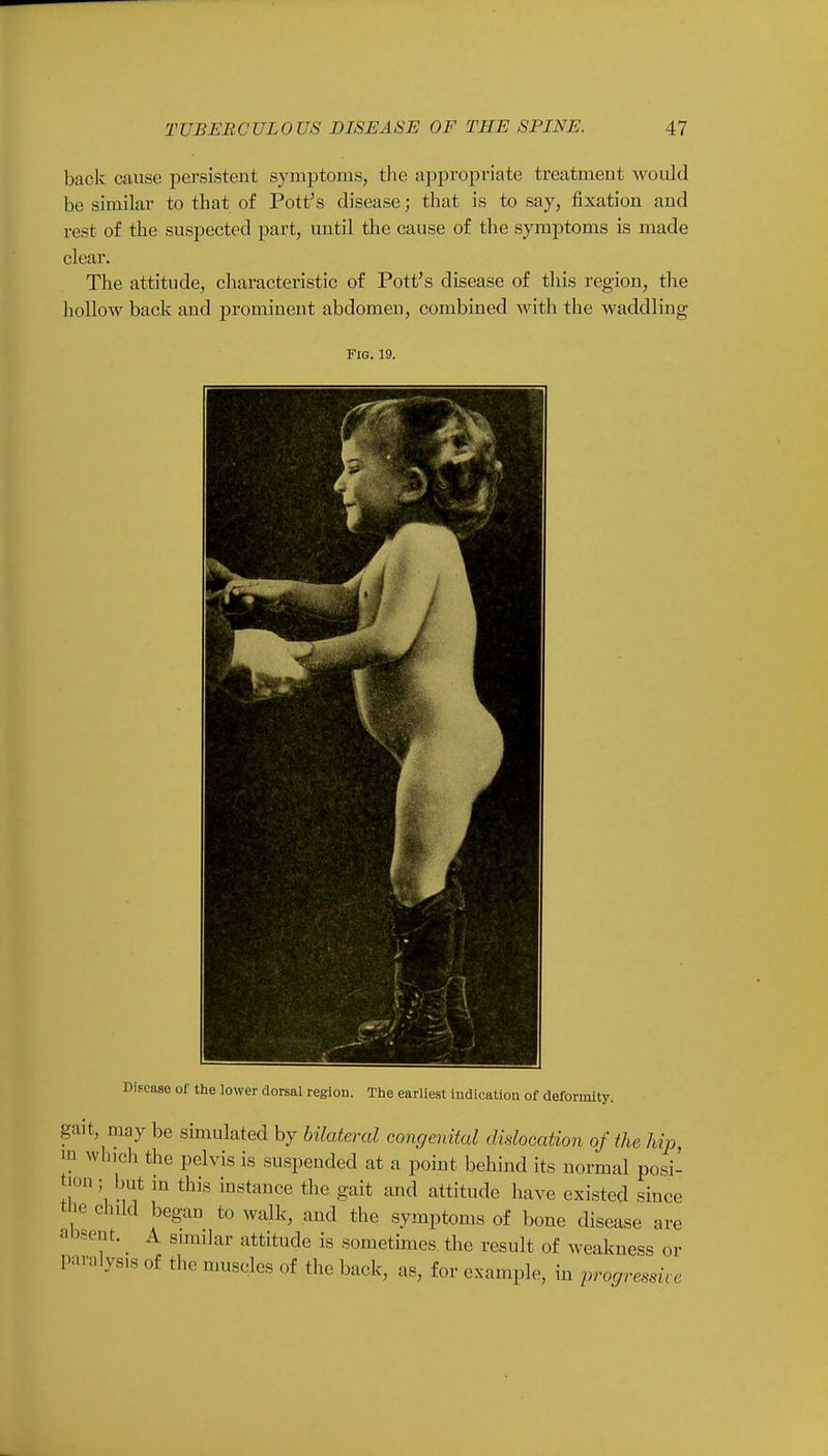 back cause persistent symptoms, the appropriate treatment would be similar to that of Pott's disease; that is to say, fixation and rest of the suspected part, until the cause of the symptoms is made clear. The attitude, characteristic of Pott's disease of this region, the hollow back and prominent abdomen, combined with the waddling Fig. 19. Disease of the lower dorsal region. The earliest indication of deformity. gait, may be simulated by bilateral congenital dislocation of the hip, m which the pelvis is suspended at a point behind its normal posi- tion ; but in this instance the gait and attitude have existed since t ie child began to walk, and the symptoms of bone disease are absent.^ A similar attitude is sometimes the result of weakness or Paralysis of the muscles of the back, as, for example, in progressive