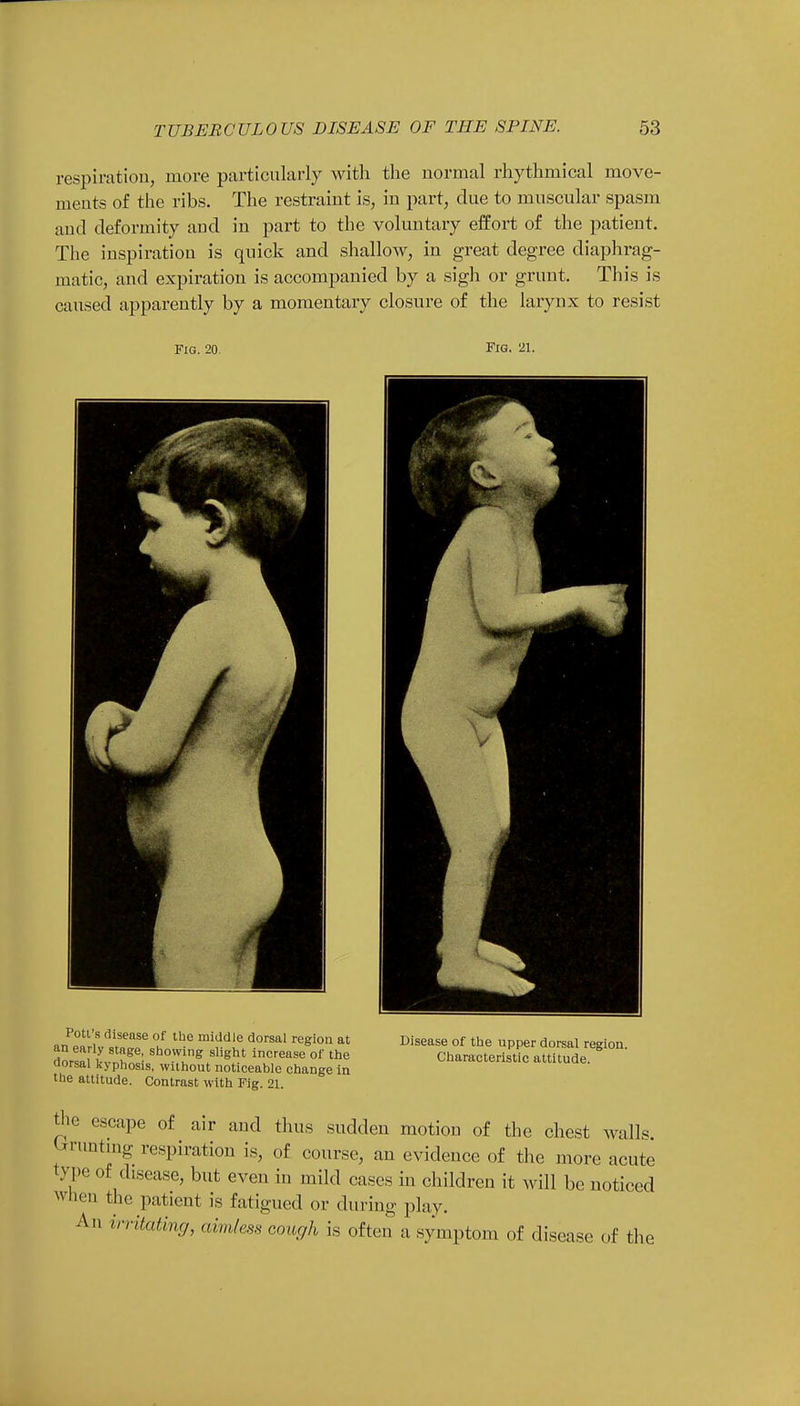 respiration, more particularly with the normal rhythmical move- ments of the ribs. The restraint is, in part, clue to muscular spasm and deformity and in part to the voluntary effort of the patient. The inspiration is quick and shallow, in great degree diaphrag- matic, and expiration is accompanied by a sigh or grunt. This is caused apparently by a momentary closure of the larynx to resist Fig. 20. Fig. 21. Potl's disease of the middle dorsal region at an early stage, showing slight increase of the dorsal kyphosis, without noticeable change in the attitude. Contrast with Fig. 21. Disease of the upper dorsal region. Characteristic attitude. the escape of air and thus sudden motion of the chest walls h unting respiration is, of course, an evidence of the more acute type of disease, but even in mild cases in children it will be noticed when the patient is fatigued or during play. An irritating, aimless cough is often a symptom of disease of the