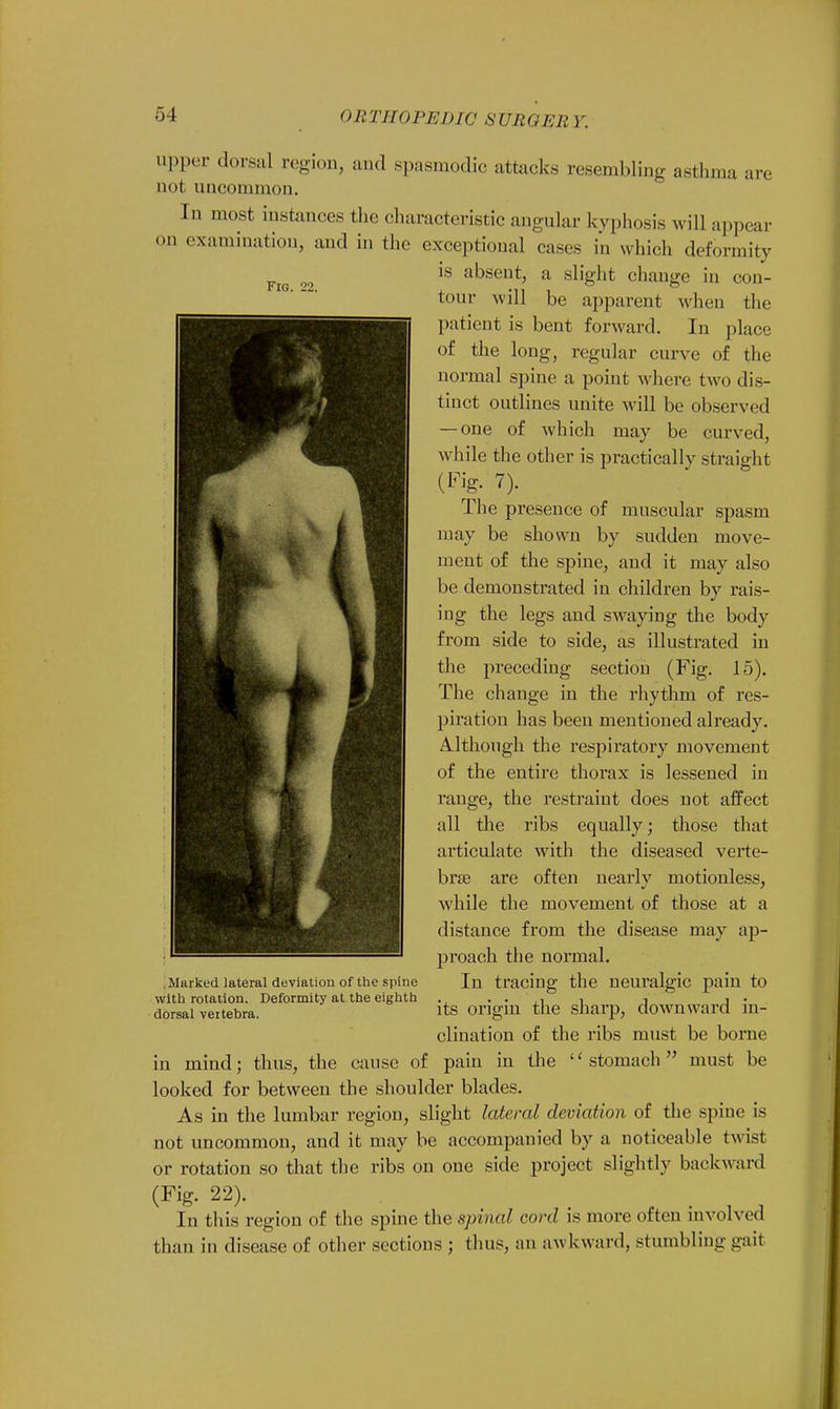 Fig. 22. upper dorsal region, and spasmodic attacks resembling asthma are not uncommon. In most instances the characteristic angular kyphosis will appear on examination, and in the exceptional cases in which deformity is absent, a slight change in con- tour will be apparent when the patient is bent forward. In place of the long, regular curve of the normal spine a point where two dis- tinct outlines unite will be observed — one of which may be curved, while the other is practically straight (Fig. 7). The presence of muscular spasm may be shown by sudden move- ment of the spine, and it may also be demonstrated in children by rais- ing the legs and swaying the body from side to side, as illustrated in the preceding section (Fig. 15). The change in the rhythm of res- piration has been mentioned already. Although the respiratory movement of the entire thorax is lessened in range, the restraint does not affect all the ribs equally; those that articulate with the diseased verte- brae are often nearly motionless, while the movement of those at a distance from the disease may ap- proach the normal. In tracing the neuralgic pain to its origin the sharp, downward in- clination of the ribs must be borne pain in the '' stomach  must be .Marked lateral deviation of the spine with rotation. Deformity at the eighth dorsal vertebra. in mind; thus, the cause of looked for between the shoulder blades. As in the lumbar region, slight lateral deviation of the spine is not uncommon, and it may be accompanied by a noticeable twisl or rotation so that the ribs on one side project slightly backward (Fig. 22). In this region of the spine the spinal con! is more often involved than in disease of other sections ; thus, an awkward, stumbling gait