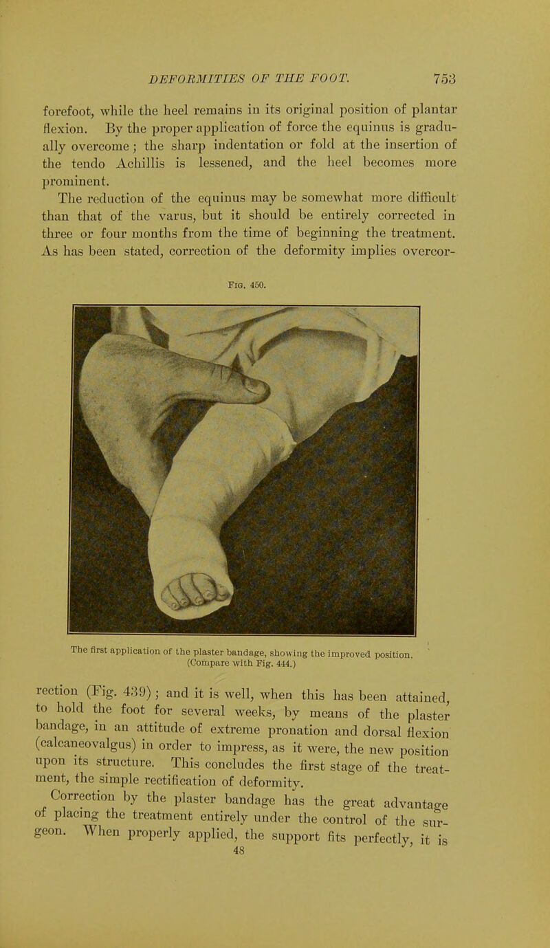 forefoot, while the heel remains in its original position of plantar flexion. By the proper application of force the equinns is gradu- ally overcome; the sharp indentation or fold at the insertion of the tendo Achillis is lessened, and the heel becomes more prominent. The reduction of the eqninus may be somewhat more difficult than that of the varus, but it should be entirely corrected in three or four months from the time of beginning the treatment. As has been stated, correction of the deformity implies overcor- Fig. 450. The first application of the plaster bandage, showing the improved position. (Compare with Fig. 444.) rection (Fig. 439); and it is well, when this has been attained, to hold the foot for several weeks, by means of the plaster bandage, in an attitude of extreme pronation and dorsal flexion (calcaneovalgus) in order to impress, as it were, the new position upon its structure. This concludes the first stage of the treat- ment, the simple rectification of deformity. Correction by the plaster bandage has the great advantage of placing the treatment entirely under the control of the sur geon. When properly applied, the support fits perfectly, it is 48