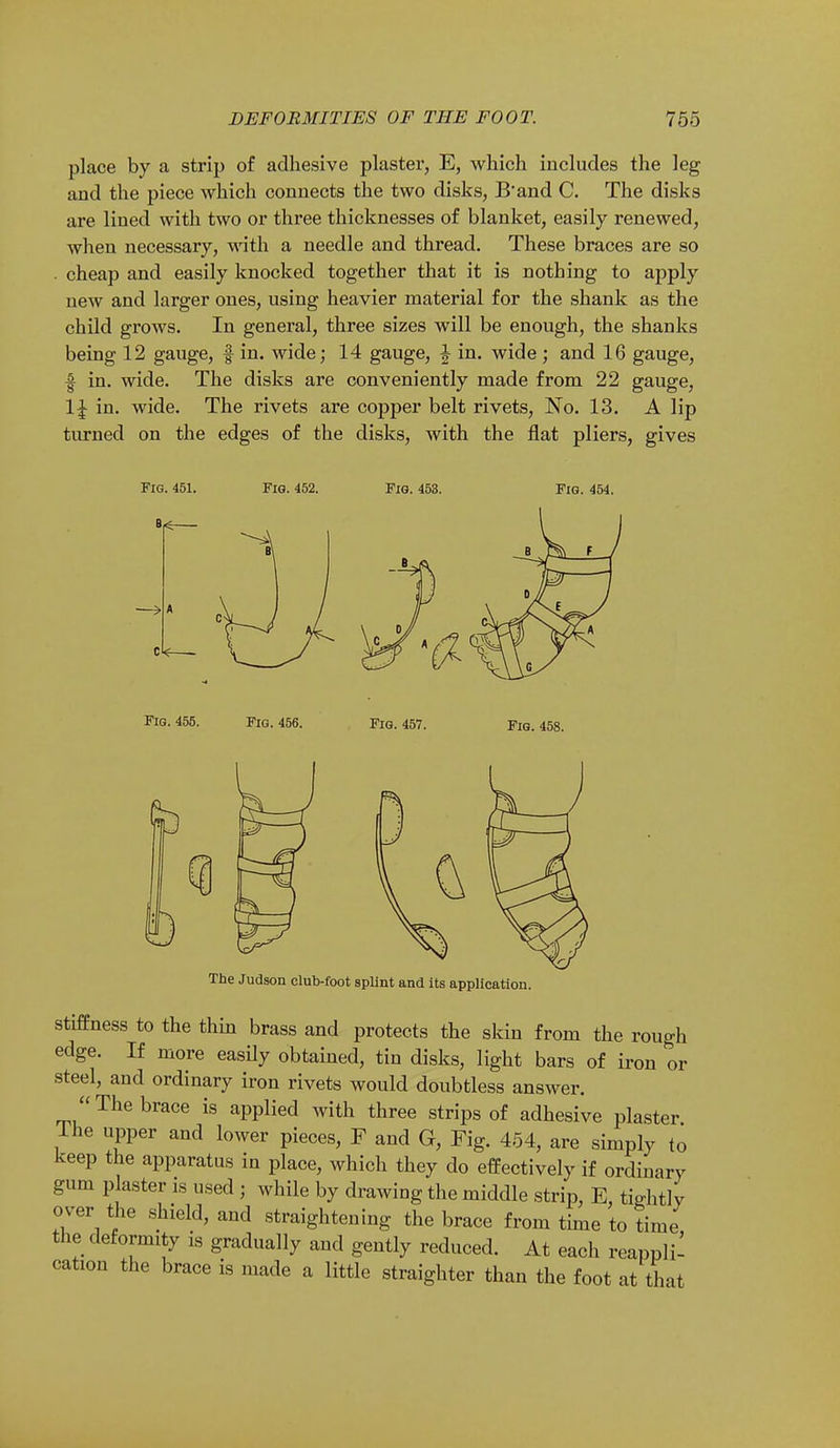 place by a strip of adhesive plaster, E, which includes the leg and the piece which connects the two disks, B'and C. The disks are lined with two or three thicknesses of blanket, easily renewed, when necessary, with a needle and thread. These braces are so cheap and easily knocked together that it is nothing to apply new and larger ones, using heavier material for the shank as the child grows. In general, three sizes will be enough, the shanks being 12 gauge, f in. wide; 14 gauge, \ in. wide ; and 16 gauge, f in. wide. The disks are conveniently made from 22 gauge, \\ in. wide. The rivets are copper belt rivets, No. 13. A lip turned on the edges of the disks, with the flat pliers, gives Fig. 451. Fig. 452. Fig. 453. Fig. 454. Fig. 455. Fig. 456. Fig. 457. Fig. 458. The Judson club-foot splint and its application. stiffness to the thin brass and protects the skin from the rough edge. If more easily obtained, tin disks, light bars of iron or steel, and ordinary iron rivets would doubtless answer.  The brace is applied Avith three strips of adhesive plaster The upper and lower pieces, F and G, Fig. 454, are simply to keep the apparatus in place, which they do effectively if ordinary gum p aster is used ; while by drawing the middle strip, E, tightly over the shield, and straightening the brace from time to time the deformity is gradually and gently reduced. At each reappli- cation the brace is made a little straighter than the foot at that