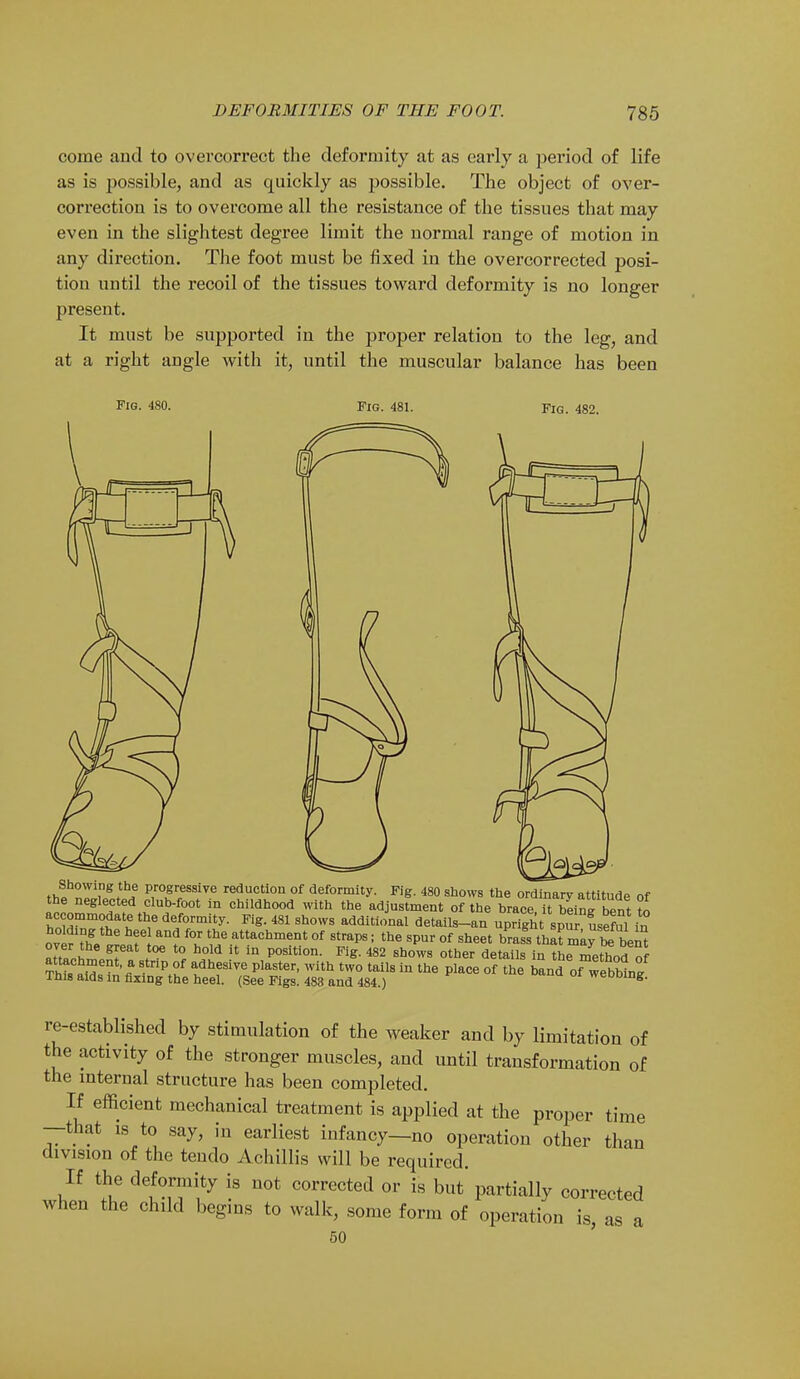 come and to overcorrect the deformity at as early a period of life as is possible, and as quickly as possible. The object of over- correction is to overcome all the resistance of the tissues that may even in the slightest degree limit the normal range of motion in any direction. The foot must be fixed in the overcorrected posi- tion until the recoil of the tissues toward deformity is no longer present. It must be supported in the proper relation to the leg, and at a right angle with it, until the muscular balance has been Fig. 480. Fig. 481. Fig. 482. th! Z ?8, ? p™Sr,essive reduction of deformity. Fig. 480 shows the ordinary attitude of the neglected club-foot in childhood with the adjustment of the brace it beineTent to accommodate the deformity. Fig. 481 shows additional details-an upright^ spur useful in ov^fL 6 aU? f°.r tbe attachment of straps i the spur of sheet LI tha?may™ben* over the great toe to hold it in position. Fig. 482 shows other details in ^method of aiXin'fl^^t0/ ^TT' WUh tW° tail8 in the Place of t^ band of webbtg ■ims aids in fixing the heel. (See Figs. 483 and 484.) vvcuuiiig. re-established by stimulation of the weaker and by limitation of the activity of the stronger muscles, and until transformation of the internal structure has been completed. If efficient mechanical treatment is applied at the proper time —that is to say, iu earliest infancy—no operation other than division of the tendo Achillis will be required. If the deformity is not corrected or is but' partially corrected when the child begins to walk, some form of operation is, as a