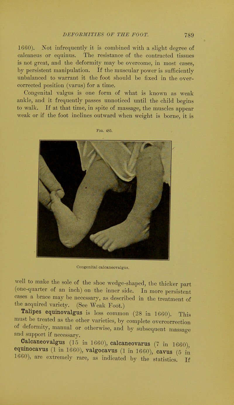 1660). Not infrequently it is combined with a slight degree of calcaneus or equinus. The resistance of the contracted tissues is not great, and the deformity may be overcome, in most cases, by persistent manipulation. If the muscular power is sufficiently unbalanced to warrant it the foot should be fixed in the over- corrected position (varus) for a time. Congenital valgus is one form of what is known as weak ankle, and it frequently passes unnoticed until the child begins to walk. If at that time, in spite of massage, the muscles appear weak or if the foot inclines outward when weight is borne, it is Fig. 485. Congenital calcaneoyalgus. well to make the sole of the shoe wedge-shaped, the thicker part (one-quarter of an inch) on the inner side. In more persistent cases a brace may be necessary, as described in the treatment of the acquired variety. (See Weak Foot.) Talipes equinovalgus is less common (28 in 1660). This must be treated as the other varieties, by complete overcorrection of deformity, manual or otherwise, and by subsequent massage and support if necessary. Calcaneovalgus (15 in 1660), calcaneovarus (7 in 1660) equinocavus (1 in 1660), valgocavus (1 in 1660), cavus (5 £ 1660), are extremely rare, as indicated by the statistics. If