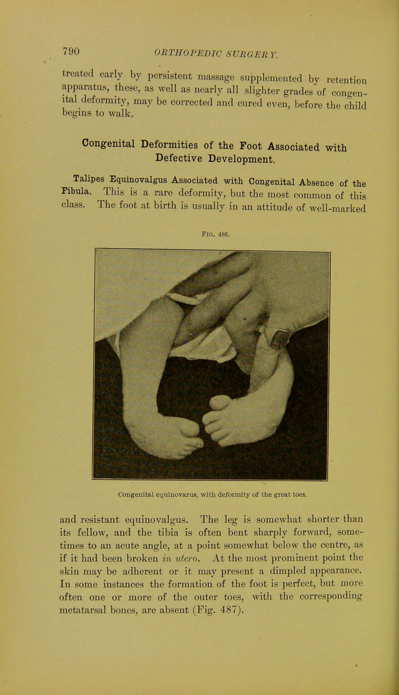 treated early by persistent massage supplemented by retention apparatus, these, as well as nearly all slighter grades of congen- ital deformity, may be corrected and cured even, before the child begins to walk. Congenital Deformities of the Foot Associated with Defective Development. ^ Talipes Equinovalgus Associated with Congenital Absence of the Fibula. This is a rare deformity, but the most common of this class. The foot at birth is usually in an attitude of well-marked Fig. 486. Congenital equinovarus, with deformity of the great toes. and resistant equinovalgus. The leg is somewhat shorter than its fellow, and the tibia is often bent sharply forward, some- times to an acute angle, at a point somewhat below the centre, as if it had been broken in utero. At the most prominent point the skin may be adherent or it may present a dimpled appearance. In some instances the formation of the foot is perfect, but mote often one or more of the outer toes, with the corresponding metatarsal bones, are absent (Fig. 487).