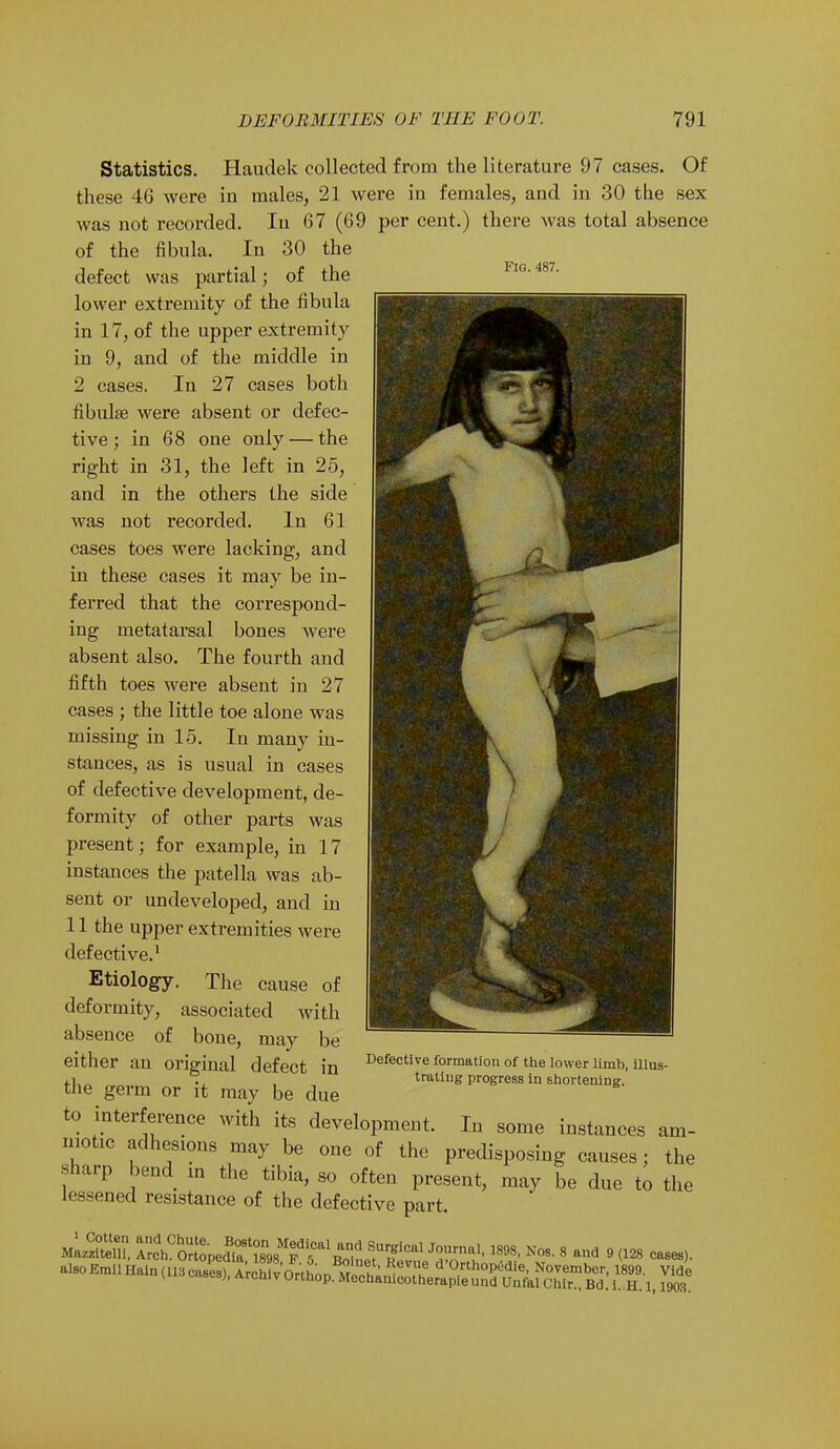 Fig. 487. Statistics. Haudek collected from the literature 97 cases. Of these 46 were in males, 21 were in females, and in 30 the sex was not recorded. In 67 (69 per cent.) there was total absence of the fibula. In 30 the defect was partial; of the lower extremity of the fibula in 17, of the upper extremity in 9, and of the middle in 2 cases. In 27 cases both fibula? were absent or defec- tive; in 68 one only — the right in 31, the left in 25, and in the others the side was not recorded. In 61 cases toes were lacking, and in these cases it may be in- ferred that the correspond- ing metatarsal bones were absent also. The fourth and fifth toes were absent in 27 cases ; the little toe alone was missing in 15. In many in- stances, as is usual in cases of defective development, de- formity of other parts was present; for example, in 17 instances the patella was ab- sent or undeveloped, and in 11 the upper extremities were defective.1 Etiology. The cause of deformity, associated with absence of bone, may be either an original defect in the germ or it may be due to interference with its development. In some instances am- niotic adhesions may be one of the predisposing causes; the sharp bend m the tibia, so often present, may be due to the lessened resistance of the defective part. mLSS lrc\CSpedtt98Tf1BriLtUrIfiCal W 1898' N0S- 8 and 9 <128 —* alsoEmilHainfllacases) Archivnr'tLn m h' eT d 0rthoP^ie, November, 1899. Vide cases), ArchivOrthop.Mechanicotherapieund Unfal Chir., Bd. i. H. 1,1903 Defective formation of the lower limb, illus- trating progress in shortening.