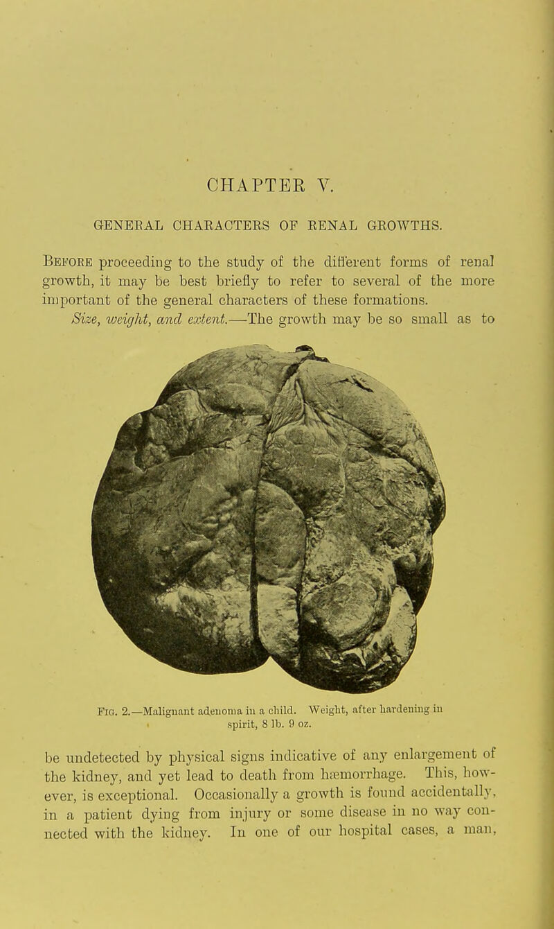 GENEEAL CHARACTERS OF RENAL GROWTHS. Before proceeding to the study of the diH'erent forms of renal growth, it may be best briefiy to refer to several of the more important of the general characters of these formations. Size, loeight, and extent.—The growth may be so small as to Fig. 2.—Malignant adenoma in a child. Weight, after hardenijig in spirit, 8 lb. 9 oz. be undetected by physical signs indicative of any enlargement of the kidney, and yet lead to death from haemorrhage. This, how- ever, is exceptional. Occasionally a growth is found accidentally, in a patient dying from injury or some disease in no way con- nected with the kidney. In one of our hospital cases, a man,