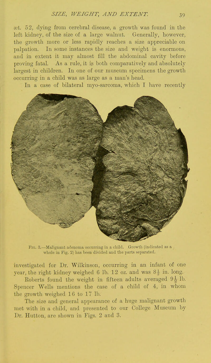 a;t. 52, dying from cerebral disease, a growth was found in the left kidney, of the size of a large walnut. Generally, however, the growth more or less rapidly reaches a size appreciable on palpation. In some instances the size and weight is enormous, and in extent it may almost fill the abdominal cavity before proving fatal. As a rule, it is both comparatively and absolutely largest in children. In one of our museum specimens the growth occurriug in a child was as large as a man's head. In a case of bilateral myo-sarcoma, which I have recently Fio. 3.—Malignant adenoma occurring in a child. Growth (indicated as a whole in Fig. 2) has been divided and the parts separated. investigated for Dr. Wilkinson, occurring in an infant of one year, the right kidney weighed 6 lb. 12 oz. and was 8i in. long. Eoberts found the weight in fifteen adults averaged 9^ lb. Spencer Wells mentions the case of a child of 4, in whom the growth weighed 16 to 17 lb. The size and general appearance of a huge malignant growth met with in a child, and presented to our College Museum by Dr. Hutton, are shown in Figs. 2 and 3.
