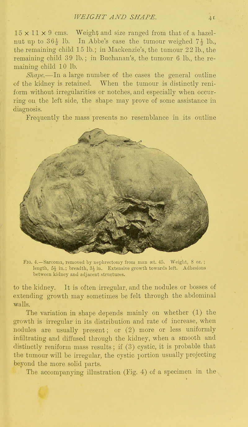 WEIGHT AND SHAPE. 15x11x9 cms. Weight and size ranged from that of a hazel- nut up to 36i lb. In Abbe's case the tumour weighed 7|- lb., the remaining child 15 lb.; in Mackenzie's, the tumour 22 lb., the remaining child 39 lb.; in Buchanan's, the tumour 6 lb., the re- maining child 10 lb. Shape.—In a large number of the cases the general outline of the kidney is retained. When the tumour is distinctly reni- form without irregularities or notches, and especially when occur- ring on the left side, the shape may prove of some assistance in diagnosis. Frequently the mass presents no resemblance in its outline Fig. 4.—Sarcoma, removed by uepbrectomy from man set. 45. Weight, 8 oz. ; length, 5^ in.; breadth, 3J in. Extensive growth towards lei't. Adhesions between kidney and adjacent structures. to the kidney. It is often irregular, and the nodules or bosses of extending growth may sometimes he felt through the abdominal walls. The variation in shape depends mainly on whether (1) the growth is irregular in its distribution and rate of increase, when nodules are usually present; or (2) more or less uniformly infiltrating and diffused through the kidney, when a smooth and distinctly reniform mass results; if (3) cystic, it is probable that the tumour will be irregular, the cystic portion usually projecting beyond the more solid parts. The accompanying illustration (Fig. 4) of a specimen in the