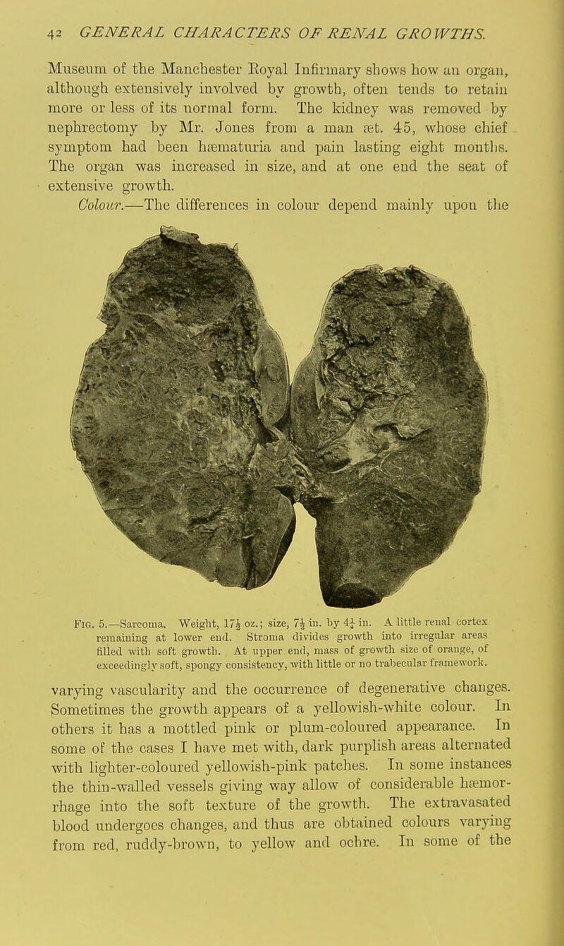 Museum of the Manchester Eoyal Infirmary shows how an organ, although extensively involved by growth, often tends to retain more or less of its normal form. The kidney was removed by nephrectomy by Mr. Jones from a man £et. 45, whose chief symptom had been htematuria and pain lasting eight montlis. The organ was increased in size, and at one end the seat of extensive growth. Colour.—The differences in colour depend mainly upon the Fig. 5.—Sarcoma. Weight, 17i oz.; .size, 74 iu. by 4^ in. A little renal cortex remaining at lower end. Stroma divides growth into irregular areas filled with soft growth. At upper end, mass of growth size of orange, of exceedingly soft, spongy consistency, with little or no trabecular framework. varying vascularity and the occurrence of degenerative changes. Sometimes the growth appears of a yellowish-white colour. In others it has a mottled pink or plum-coloured appearance. In some of the cases I have met with, dark purplish areas alternated with lighter-coloured yellowish-pink patches. In some instances the thin-waUed vessels giving way allow of considerable haemor- rhage into the soft texture of the growth. The extravasated blood undergoes changes, and thus are obtained colours varying from red, ruddy-brown, to yellow and ochre. In some of the
